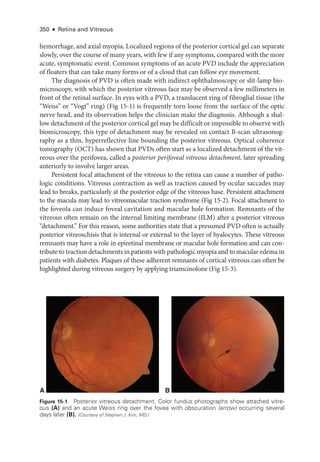 350 ● Retina and Vitreous
hemorrhage, and axial myopia. Localized regions of the posterior cortical gel can separate
slowly, over the course of many years, with few if any symptoms, compared with the more
acute, symptomatic event. Common symptoms of an acute PVD include the appreciation
of floaters that can take many forms or of a cloud that can follow eye movement.
The diagnosis of PVD is often made with indirect ophthalmoscopy or slit-­
lamp bio-
microscopy, with which the posterior vitreous face may be observed a few millimeters in
front of the ret­
i­
nal surface. In eyes with a PVD, a translucent ring of fibroglial tissue (the
“Weiss” or “Vogt” ring) (Fig 15-1) is frequently torn loose from the surface of the optic
nerve head, and its observation helps the clinician make the diagnosis. Although a shal-
low detachment of the posterior cortical gel may be difficult or impossible to observe with
biomicroscopy, this type of detachment may be revealed on contact B-­
scan ultrasonog-
raphy as a thin, hyperreflective line bounding the posterior vitreous. Optical coherence
tomography (OCT) has shown that PVDs often start as a localized detachment of the vit-
reous over the perifovea, called a posterior perifoveal vitreous detachment, ­
later spreading
anteriorly to involve larger areas.
Per­
sis­
tent focal attachment of the vitreous to the ret­
ina can cause a number of patho-
logic conditions. Vitreous contraction as well as traction caused by ocular saccades may
lead to breaks, particularly at the posterior edge of the vitreous base. Per­
sis­
tent attachment
to the macula may lead to vitreomacular traction syndrome (Fig 15-2). Focal attachment to
the foveola can induce foveal cavitation and macular hole formation. Remnants of the
vitreous often remain on the internal limiting membrane (ILM) ­
after a posterior vitreous
“detachment.” For this reason, some authorities state that a presumed PVD often is actually
posterior vitreoschisis that is internal or external to the layer of hyalocytes. ­
These vitreous
remnants may have a role in epiret­
i­
nal membrane or macular hole formation and can con-
tribute to traction detachments in patients with pathologic myopia and to macular edema in
patients with diabetes. Plaques of ­
these adherent remnants of cortical vitreous can often be
highlighted during vitreous surgery by applying triamcinolone (Fig 15-3).
A B
Figure 15-1 Posterior vitreous detachment. Color fundus photo­
graphs show attached vitre-
ous (A) and an acute Weiss ring over the fovea with obscuration (arrow) occurring several
days ­later (B). (Courtesy of Stephen J. Kim, MD.)
 