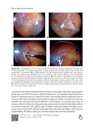 352 ● Retina and Vitreous
is produced when this preret­i­nal membrane contracts to the edge of the clivus, steepening the
gentle slope around the fovea into a cylindrical depression. Occasionally, intraret­
i­
nal hemor-
rhages or whitened patches of superficial ret­
ina representing delayed axoplasmic flow in
the nerve fiber layer and edema may be pre­
sent, which can imitate a ret­
i­
nal vein occlusion.
Lamellar hole–­
associated epiret­
i­
nal proliferation (LHEP) features an avascular tissue layer of
medium reflectivity that covers the premacular surface and surrounds a foveal defect without
a tractional component. The cellular origin of ERMs is still ­
under debate. Histologic exami-
nation reveals mainly RPE cells and ret­
i­
nal glial cells (astrocytes and Müller cells); however,
myofibroblasts, fibroblasts, hyalocytes, and macrophages have also been identified.
ACTIVITY 15-1 OCT Activity: Epiret­i­nal membrane.
Courtesy of Colin A. McCannel, MD.
A B
C D
Figure 15-3 Visualization of a thin layer of adherent vitreous during vitrectomy with the use
of triamcinolone. This patient appeared to have a posterior vitreous detachment (PVD) and
underwent a vitrectomy. A, A small amount of triamcinolone was injected into the vitreous
cavity; the excess was aspirated from the surface of the ret­
ina, leaving a fine distribution
of triamcinolone sticking to the adherent vitreous. B, The vitreous membrane was elevated
using a diamond-­
dusted silicone scraper. Note that the vitreous is difficult to see; the sheet
of triamcinolone is the clue to its presence. C, A wide-­
angle viewing system then was used
to visualize the elevation of the adherent vitreous, and the vitrector was set to suction only.
D, Note the extent of the adherent vitreous sheet, which was removed with the vitrector set to
cut. (Courtesy of Richard F
. Spaide, MD.)
 