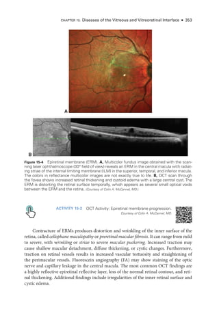 ACTIVITY 15-2 OCT Activity: Epiret­
i­
nal membrane progression.
Courtesy of Colin A. McCannel, MD.
Contracture of ERMs produces distortion and wrinkling of the inner surface of the
ret­ina, called cellophane maculopathy or preret­i­nal macular fibrosis. It can range from mild
to severe, with wrinkling or striae to severe macular puckering. Increased traction may
cause shallow macular detachment, diffuse thickening, or cystic changes. Furthermore,
traction on ret­
i­
nal vessels results in increased vascular tortuosity and straightening of
the perimacular vessels. Fluorescein angiography (FA) may show staining of the optic
nerve and capillary leakage in the central macula. The most common OCT findings are
a highly reflective epiret­
i­
nal reflective layer, loss of the normal ret­
i­
nal contour, and ret­
i­
nal thickening. Additional findings include irregularities of the inner ret­
i­
nal surface and
cystic edema.
B
A
Figure 15-4 Epiretinal membrane (ERM). A, Multicolor fundus image obtained with the scan-
ning ­
laser ophthalmoscope (30° field of view) reveals an ERM in the central macula with radiat-
ing striae of the internal limiting membrane (ILM) in the superior, temporal, and inferior macula.
The colors in reflectance multicolor images are not exactly true to life. B, OCT scan through
the fovea shows increased ret­
i­
nal thickening and cystoid edema with a large central cyst. The
ERM is distorting the ret­
i­
nal surface temporally, which appears as several small optical voids
between the ERM and the ret­
ina. (Courtesy of Colin A. McCannel, MD.)
CHAPTER 15: Diseases of the Vitreous and Vitreoret­
i­
nal Interface ● 353
 