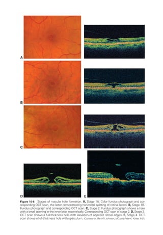 C
A
B
D E
Figure 15-6 Stages of macular hole formation. A, Stage 1A. Color fundus photo­
graph and cor-
responding OCT scan, the latter demonstrating horizontal splitting of ret­
i­
nal layers. B, Stage 1B.
Fundus photo­
graph and corresponding OCT scan. C, Stage 2. Fundus photo­
graph shows a hole
with a small opening in the inner layer eccentrically. Corresponding OCT scan of stage 2. D, Stage 3.
OCT scan shows a full-­
thickness hole with elevation of adjacent ret­
i­
nal edges. E, Stage 4. OCT
scan shows a full-­
thickness hole with operculum. (Courtesy of Mark W. Johnson, MD, and Peter K. Kaiser, MD.)
 