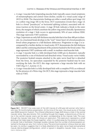 • A stage 1 macular hole (impending macular hole) typically ­
causes visual symptoms
of metamorphopsia and central vision decline, usually to a visual acuity range of
20/25 to 20/60. The characteristic findings are ­
either a small yellow spot (stage 1A)
or a yellow ring (stage 1B) in the fovea. OCT examination reveals that a stage 1A
hole is a foveal “pseudocyst,” or horizontal splitting (schisis), associated with vit-
reous traction on the foveal center. A stage 1B hole indicates a break in the outer
fovea, the margins of which constitute the yellow ring noted clinically. Spontaneous
resolution of a stage 1 hole occurs in approximately 50% of cases without ERM.
This stage represents VMT syndrome.
• Stage 2 represents an early full-­thickness macular hole that is less than 400 µm in diam-
eter. As a tractional break develops in the “roof” (inner layer) of a foveal pseudocyst,
foveal schisis progresses to a full-­
thickness dehiscence. Progression to stage 2 is ac-
companied by a further decline in visual acuity. OCT demonstrates the full-­
thickness
defect and the continuing attachment of the posterior hyaloid to the foveal center. This
stage represents VMT syndrome with a small-­to medium-­
sized macular hole.
• A stage 3 macular hole is a fully developed hole (●400 µm in dia­
meter), typically
surrounded by a rim of thickened and detached ret­
ina. Visual acuity varies widely.
The posterior hyaloid remains attached to the optic nerve head but is detached
from the fovea. An operculum suspended by the posterior hyaloid may be seen
overlying the hole. On OCT, this stage represents a large macular hole with no
VMT (Fig 15-7, Activity 15-3).
• A stage 4 macular hole is a fully developed hole with a complete PVD, as evidenced
by the presence of a Weiss ring. On OCT, this stage represents a large macular hole
with no VMT.
Figure 15-7 SD-­
OCT line cube scan of the left macula of a 62-­
year-­
old ­
woman who had vi-
sion loss 18 months before pre­
sen­
ta­
tion. At the time of the scan, the visual acuity of this eye
was 20/40 (eccentric fixation). The infrared reflectance image (left) shows a hole in the central
macular ret­
ina. See also Activity 15-3; scrolling through the images, a discontinuity of the ret­
ina in the central macular scans can be seen, corresponding to the macular hole. The scan
through the macular hole (scan 10) shows an operculum. This operculum represents a small
glial plug that helps keep the fovea together; when it is pulled away by the posterior vitreous,
a macular hole is facilitated. Histologic studies indicate that the number of photoreceptors at-
tached to the plug can vary, from none to many.The prominent posterior vitreous face can also
be seen; its contour suggests that it is likely attached at the optic nerve head and peripheral
macula (dome-­
shaped configuration), which is typical in idiopathic macular holes. (Courtesy of
Colin A. McCannel, MD.)
CHAPTER 15: Diseases of the Vitreous and Vitreoret­
i­
nal Interface ● 357
 