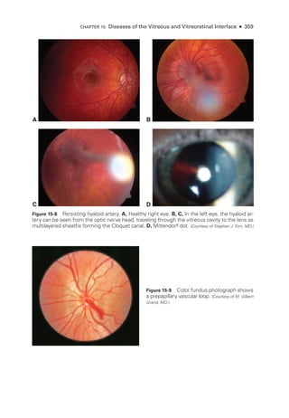 A B
C D
Figure 15-8 Persisting hyaloid artery. A, Healthy right eye. B, C, In the left eye, the hyaloid ar-
tery can be seen from the optic nerve head, traveling through the vitreous cavity to the lens as
multilayered sheaths forming the Cloquet canal. D, Mittendorf dot. (Courtesy of Stephen J. Kim, MD.)
Figure 15-9 Color fundus photo­
graph shows
a pre­
papillary vascular loop. (Courtesy of M. Gilbert
­Grand, MD.)
CHAPTER 15: Diseases of the Vitreous and Vitreoret­
i­
nal Interface ● 359
 