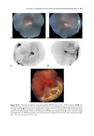 A B
C D
E
Figure 15-11 Familial exudative vitreoretinopathy (FEVR) due to the LRP5 mutation. A, B, The
temporal ret­
ina shows a zone of nonperfusion that is horizontally V-­
shaped, causing a tractional
macular fold. C, D, Fluorescein angiography images from the same patient demonstrate drag-
ging of the vasculature. ­
There is evidence of leakage and avascularity. E, Color fundus image
montage from a dif­
fer­
ent patient with FEVR shows folding of the ret­
ina with massive exuda-
tion. (Courtesy of Audina M. Berrocal, MD.)
CHAPTER 15: Diseases of the Vitreous and Vitreoret­
i­
nal Interface ● 363
 