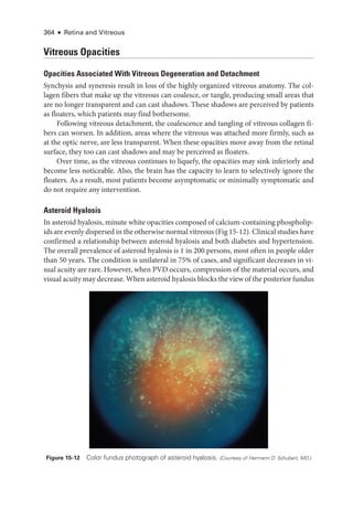 364 ● Retina and Vitreous
Vitreous Opacities
Opacities Associated With Vitreous Degeneration and Detachment
Synchysis and syneresis result in loss of the highly or­
ga­
nized vitreous anatomy. The col-
lagen fibers that make up the vitreous can coalesce, or tangle, producing small areas that
are no longer transparent and can cast shadows. ­
These shadows are perceived by patients
as floaters, which patients may find bothersome.
Following vitreous detachment, the coalescence and tangling of vitreous collagen fi-
bers can worsen. In addition, areas where the vitreous was attached more firmly, such as
at the optic nerve, are less transparent. When ­
these opacities move away from the ret­
i­
nal
surface, they too can cast shadows and may be perceived as floaters.
Over time, as the vitreous continues to liquefy, the opacities may sink inferiorly and
become less noticeable. Also, the brain has the capacity to learn to selectively ignore the
floaters. As a result, most patients become asymptomatic or minimally symptomatic and
do not require any intervention.
Asteroid Hyalosis
In asteroid hyalosis, minute white opacities composed of calcium-­
containing phospholip-
ids are evenly dispersed in the other­wise normal vitreous (Fig 15-12). Clinical studies have
confirmed a relationship between asteroid hyalosis and both diabetes and hypertension.
The overall prevalence of asteroid hyalosis is 1 in 200 persons, most often in ­
people older
than 50 years. The condition is unilateral in 75% of cases, and significant decreases in vi-
sual acuity are rare. However, when PVD occurs, compression of the material occurs, and
visual acuity may decrease. When asteroid hyalosis blocks the view of the posterior fundus
Figure 15-12 Color fundus photo­
graph of asteroid hyalosis. (Courtesy of Hermann D. Schubert, MD.)
 