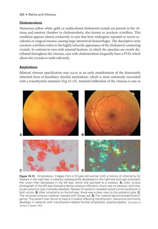 366 ● Retina and Vitreous
Cholesterolosis
Numerous yellow-­
white, gold, or multicolored cholesterol crystals are pre­
sent in the vit-
reous and anterior chamber in cholesterolosis, also known as synchysis scintillans. This
condition appears almost exclusively in eyes that have under­
gone repeated or severe ac-
cidental or surgical trauma causing large intravitreal hemorrhages. The descriptive term
synchysis scintillans refers to the highly refractile appearance of the cholesterol-­containing
crystals. In contrast to eyes with asteroid hyalosis, in which the opacities are evenly dis-
tributed throughout the vitreous, eyes with cholesterolosis frequently have a PVD, which
allows the crystals to ­
settle inferiorly.
Amyloidosis
Bilateral vitreous opacification may occur as an early manifestation of the dominantly
inherited form of hereditary familial amyloidosis, which is most commonly associated
with a transthyretin mutation (Fig 15-13). Amyloid infiltration of the vitreous is rare in
A
C
B
D
Figure 15-13 Amyloidosis. Images from a 57-­
year-­
old ­
woman with a history of vitrectomy for
floaters in the right eye. A cataract subsequently developed in the right eye and was extracted.
Her vision then decreased in the left eye, which she ascribed to a cataract. A, Color fundus
photo­
graph of the left eye showed a dense vitreous infiltration; ­
there was no cataract, and intra-
ocular pressure was markedly elevated. Review of systems revealed carpal tunnel syndrome in
both wrists. B, ­
After vitrectomy on the left eye, ­
there was a clear view to the posterior pole. C,
The removed vitreous material, stained with Congo red. D, The material demonstrated birefrin-
gence. The patient was found to have a mutation affecting transthyretin. Glaucoma commonly
develops in patients with transthyretin-­
related familial amyloidotic polyneuropathy. (Courtesy of
Richard F
. Spaide, MD.)
 