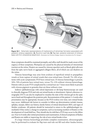 370 ● Retina and Vitreous
­
these symptoms should be examined promptly, and office staff should be made aware of the
urgency of ­
these symptoms. Photopsias are caused by the physical stimulus of vitreoret­
i­
nal
traction on the ret­
ina. Floaters are caused by vitreous opacities such as blood, glial cells torn
from the optic nerve head, or aggregated collagen fibers, all of which can cast shadows on
the ret­ina.
Vitreous hemorrhage may arise from avulsion of superficial ret­
i­
nal or prepapillary
vessels or from rupture of ret­
i­
nal vessels that cross ret­
i­
nal tears. Overall, 7%–18% of pa­
tients with acute symptomatic PVD have ret­
i­
nal tears. If vitreous hemorrhage is pre­
sent,
50%–70% of patients have ret­
i­
nal tears, versus 7%–12% without vitreous hemorrhage.
Patients with an acute PVD complicated by a ret­i­nal tear are 7 times more likely to pre­sent
with vitreous pigment or granules than are ­
those without a tear.
Indirect ophthalmoscopy with scleral depression or slit-­
lamp biomicroscopy are used
to clinically diagnose PVD and rule out ret­
i­
nal breaks or detachment. Optical coherence to­
mography (OCT) can also be employed to visualize the state of the vitreous gel on the optic
nerve head and throughout the posterior pole. Reexamination of the patient 2–4 weeks ­
after
pre­
sen­
ta­
tion may be appropriate, ­
because as the PVD evolves over time, new ret­
i­
nal breaks
may occur. Additional risk ­
factors to consider in follow-up determination include trauma,
aphakia, myopia, fellow-­
eye history, ­
family history of ret­
i­
nal detachment (RD), and signs of
Stickler syndrome. All patients should be instructed to return to the ophthalmologist im­
mediately if they notice a change in symptoms, such as increasing numbers of floaters or the
development of visual field loss. They should also be told that a PVD may occur in the fellow
eye. Four to 8 weeks ­
after initial pre­
sen­
ta­
tion and examination, if clinical symptoms of flashes
and floaters are stable or improving, the risk of new ret­
i­
nal breaks is low.
If a large vitreous hemorrhage precludes complete examination, ultrasonography
may be performed to evaluate for flap tears and rule out RD and other fundus lesions.
B
A
Figure 16-1 Schematic repre­
sen­
ta­
tions of mechanisms of ret­
i­
nal tear formation associated with
posterior vitreous separation. A, Round or oval hole. B, Flap tear: posterior extension of vitreous
base with firm vitreoret­
i­
nal attachment. (Illustration by Christine Gralapp, based on illustrations byTim Hengst.)
 