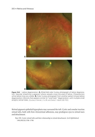372 ● Retina and Vitreous
Ret­
i­
nal pigment epithelial hyperplasia may surround the tuft. Cystic and zonular traction
ret­
i­
nal tufts, both with firm vitreoret­
i­
nal adhesions, may predispose eyes to ret­
i­
nal tears
and detachment.
Byer NE. Cystic ret­
i­
nal tufts and their relationship to ret­
i­
nal detachment. Arch Ophthalmol.
1981;99(10):1788–1790.
A
B
Figure 16-2 Lattice degeneration. A, Wide-­
field color fundus photo­
graph of lattice degenera-
tion. Vascular sheathing is apparent where vessels cross the area of lattice. Characteristic
white lattice lines are vis­
i­
ble. B, Color fundus photo­
graph from another patient shows lattice
degeneration inferiorly that appears similar to “snail track” degeneration, with multiple small
atrophic ret­i­nal holes. (Courtesy of Hannah J. Yu, BS, and Charles C. Wykoff, MD, PhD.)
 
