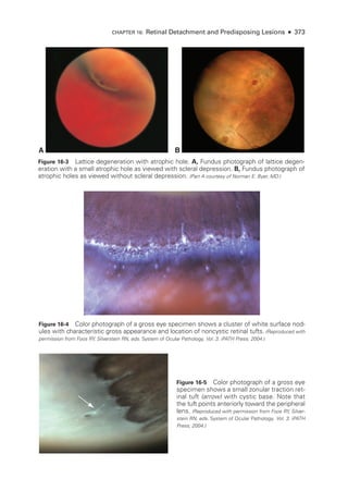CHAPTER 16: Ret­
i­
nal Detachment and Predisposing Lesions ● 373
A B
Figure 16-3 Lattice degeneration with atrophic hole. A, Fundus photo­
graph of lattice degen-
eration with a small atrophic hole as viewed with scleral depression. B, Fundus photo­
graph of
atrophic holes as viewed without scleral depression. (Part A courtesy of Norman E. Byer, MD.)
Figure 16-4 Color photo­
graph of a gross eye specimen shows a cluster of white surface nod-
ules with characteristic gross appearance and location of noncystic ret­
i­
nal tufts. (Reproduced with
permission from Foos RY, Silverstein RN, eds. System of Ocular Pathology. Vol. 3. iPATH Press; 2004.)
Figure 16-5 Color photo­
graph of a gross eye
specimen shows a small zonular traction ret-
inal tuft (arrow) with cystic base. Note that
the tuft points anteriorly ­
toward the peripheral
lens. (Reproduced with permission from Foos RY, Silver-
stein RN, eds. System of Ocular Pathology. Vol. 3. iPATH
Press; 2004.)
 