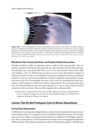 374 ● Retina and Vitreous
Meridional Folds, Enclosed Ora Bays, and Peripheral Ret­
i­
nal Excavations
Meridional folds are folds of redundant ret­
ina, usually located superonasally. They are
usually associated with dentate pro­
cesses but may also extend posteriorly from ora bays.
Occasionally, tears associated with PVD occur at the most posterior limit of the folds
(see Chapter 1, Fig 1-3). Ret­
i­
nal tears can also occur at or near the posterior margins of
enclosed ora bays, which are oval islands of pars plana epithelium located immediately
posterior to the ora serrata and completely or almost completely surrounded by periph­
eral ret­
ina (Fig 16-6). Occasionally, tears may occur at the site of peripheral ret­
i­
nal exca­
vations, which represent a mild form of lattice degeneration. The excavations may have
firm vitreoret­
i­
nal adhesions and are found adjacent to, or up to 4 disc dia­
meters (DDs)
posterior to, the ora serrata. They are often aligned with meridional folds.
Engstrom RE Jr, Glasgow BJ, Foos RY, Straatsma BR. Degenerative diseases of the peripheral
ret­
ina. In: Tasman W, Jaeger EA, eds. Duane’s Clinical Ophthalmology on DVD-­
ROM. Vol 3.
Lippincott Williams  Wilkins; 2013:chap 26.
Lesions That Do Not Predispose Eyes to Ret­
i­
nal Detachment
Paving-­Stone Degeneration
Cobblestone (or paving-­stone) degeneration is characterized by peripheral, discrete areas of
ret­i­nal atrophy (Fig 16-7); it appears in 22% of individuals older than 20 years. The atrophic
areas may occur singly or in groups and are sometimes confluent. On histologic examina­
tion, ­
these “paving stones” are characterized by atrophy of the ret­
i­
nal pigment epithelium
(RPE) and outer ret­
i­
nal layers, attenuation or absence of the choriocapillaris, and adhesions
*
Figure 16-6 Color photo­
graph of a gross eye specimen shows a meridional complex, consist-
ing of an aty­
pi­
cal and large dentate pro­
cess (white arrow) that is continuous with a ciliary
pro­
cess of the pars plicata and an area of enclosed pars plana and ora bay (asterisk). Slightly
posterior to the complex is a small area in the same meridian that appears to be excavated
but is in fact a cyst (arrowhead). (Modified with permission from Foos RY, Silverstein RN, eds. System of Ocular
Pathology. Vol. 3. iPATH Press; 2004.)
 