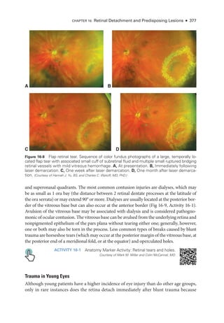 CHAPTER 16: Ret­
i­
nal Detachment and Predisposing Lesions ● 377
and superonasal quadrants. The most common contusion injuries are dialyses, which may
be as small as 1 ora bay (the distance between 2 ret­
i­
nal dentate pro­
cesses at the latitude of
the ora serrata) or may extend 90° or more. Dialyses are usually located at the posterior bor­
der of the vitreous base but can also occur at the anterior border (Fig 16-9, Activity 16-1).
Avulsion of the vitreous base may be associated with dialysis and is considered pathogno­
monic of ocular contusion. The vitreous base can be avulsed from the under­
lying ret­
ina and
nonpigmented epithelium of the pars plana without tearing ­
either one; generally, however,
one or both may also be torn in the pro­
cess. Less common types of breaks caused by blunt
trauma are ­
horse­
shoe tears (which may occur at the posterior margin of the vitreous base, at
the posterior end of a meridional fold, or at the equator) and operculated holes.
ACTIVITY 16-1 Anatomy Marker Activity: Ret­
i­
nal tears and holes.
Courtesy of Mark M. Miller and Colin McCannel, MD.
Trauma in Young Eyes
Although young patients have a higher incidence of eye injury than do other age groups,
only in rare instances does the ret­
ina detach immediately ­
after blunt trauma ­
because
C D
A B
Figure 16-8 Flap ret­
i­
nal tear. Sequence of color fundus photo­
graphs of a large, temporally lo-
cated flap tear with associated small cuff of subret­
i­
nal fluid and multiple small ruptured bridging
ret­
i­
nal vessels with mild vitreous hemorrhage. A, At pre­sen­ta­tion. B, Immediately following
­laser demarcation. C, One week ­
after ­
laser demarcation. D, One month ­
after ­
laser demarca-
tion. (Courtesy of Hannah J. Yu, BS, and Charles C. Wykoff, MD, PhD.)
 