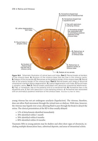 378 ● Retina and Vitreous
young vitreous has not yet under­
gone synchysis (liquefaction). The vitreous, therefore,
does not allow fluid movement through the ret­
i­
nal tears or dialyses. With time, however,
the vitreous may liquefy over a tear, allowing fluid to pass through the break to detach the
ret­
ina. The clinical pre­
sen­
ta­
tion of the RD is thus usually delayed:
• 12% of detachments identified immediately
• 30% identified within 1 month
• 50% identified within 8 months
• 80% identified within 24 months
Traumatic RDs in young patients may be shallow and often show signs of chronicity, in­
cluding multiple demarcation lines, subret­
i­
nal deposits, and areas of intraret­
i­
nal schisis.
Figure 16-9 Schematic illustration of ret­
i­
nal tears and holes. Part 1: Ret­
i­
nal breaks at borders
of the vitreous base. A, Avulsion of the vitreous base that lies ­
free in the vitreous cavity.
B, ­
Dialysis of the ora serrata. C, Ret­
i­
nal tear at the posterior border of the vitreous base. D, Ret­i­nal
tear at the anterior border of the vitreous base. Part 2: Ret­
i­
nal breaks with areas of abnormal
vitreoret­
i­
nal interface (lattice degeneration). E, Lattice degeneration with holes. F, Round holes
in atrophic ret­
ina. Part 3: Ret­
i­
nal breaks associated with abnormal vitreoret­
i­
nal attachments.
G, Flap, or ­
horse­
shoe, tear at the posterior end of a meridional fold. H, Horse­
shoe tear in the
equatorial zone. I, Tear with operculum in the overlying vitreous. J, Horse­
shoe tear associated
with an anomalous posterior extension of the vitreous base. (Illustration by Mark M. Miller.)
D, Retinal tear at
anterior border
of vitreous base
C, Retinal tear at
posterior border of
vitreous base
A, Avulsion of
vitreous base
that lies free in
vitreous cavity
F, Round holes in
atrophic retina
E, Lattice degeneration
with holes J, Horseshoe-shaped
tear associated with
an anomalous posterior
extension of the
vitreous base
G, Horseshoe-shaped tear
at posterior end of meridional fold
H, Horseshoe-shaped tear
in equatorial zone
I, Tear with operculum
in overlying vitreous
2 3
1
B, Dialysis at ora serrata
 