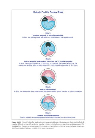 Rule 1:
Superior temporal or nasal detachments:
In 98%, the primary break lies within 11
/2 clock-hours of the highest border.
Rules to Find the Primary Break
Rule 2:
Total or superior detachments that cross the 12 o’clock meridian:
In 93%, the primary break is at 12 o’clock or in a triangle, the apex of which is at the
ora serrata, and the sides of which extend 11
/2 clock-hours to either side of 12 o’clock.
Rule 3:
Inferior detachments:
In 95%, the higher side of the detachment indicates on which side of the disc an inferior break lies.
Rule 4:
“Inferior” bullous detachment:
Inferior bullae in a rhegmatogenous detachment originate from a superior break.
95%
98%
Figure 16-11 Lincoff rules for finding the primary ret­
i­
nal break. Guttering, as illustrated in Rule 4,
may be difficult to identify and may require indirect ophthalmoscopy with scleral depression for
visualization. (Reproduced with permission from Kreissig I. A Practical Guide to Minimal Surgery for Ret­
i­
nal Detachment.
Vol 1.Thieme Medical Publishers, Inc; 2000:13–18. www.thieme.com.)
 