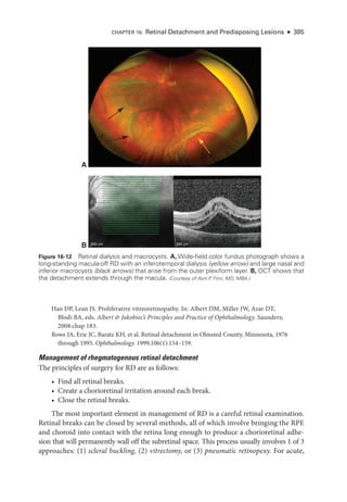 CHAPTER 16: Ret­
i­
nal Detachment and Predisposing Lesions ● 385
Han DP, Lean JS. Proliferative vitreoretinopathy. In: Albert DM, Miller JW, Azar DT,
Blodi BA, eds. Albert  Jakobiec’s Princi­
ples and Practice of Ophthalmology. Saunders;
2008:chap 183.
Rowe JA, Erie JC, Baratz KH, et al. Ret­
i­
nal detachment in Olmsted County, Minnesota, 1976
through 1995. Ophthalmology. 1999;106(1):154–159.
Management of rhegmatogenous ret­
i­
nal detachment
The princi­
ples of surgery for RD are as follows:
• Find all ret­
i­
nal breaks.
• Create a chorioret­
i­
nal irritation around each break.
• Close the ret­
i­
nal breaks.
The most impor­
tant ele­
ment in management of RD is a careful ret­
i­
nal examination.
Ret­
i­
nal breaks can be closed by several methods, all of which involve bringing the RPE
and choroid into contact with the ret­
ina long enough to produce a chorioret­
i­
nal adhe­
sion that ­
will permanently wall off the subret­
i­
nal space. This pro­
cess usually involves 1 of 3
approaches: (1) scleral buckling, (2) vitrectomy, or (3) pneumatic retinopexy. For acute,
B 200 μm 200 μm
A
Figure 16-12 Retinal dialysis and macrocysts. A, Wide-field color fundus photo­
graph shows a
long-­
standing macula-­
off RD with an inferotemporal dialysis (yellow arrow) and large nasal and
inferior macrocysts (black arrows) that arise from the outer plexiform layer. B, OCT shows that
the detachment extends through the macula. (Courtesy of Avni P
. Finn, MD, MBA.)
 