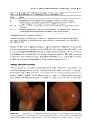 CHAPTER 16: Ret­
i­
nal Detachment and Predisposing Lesions ● 387
macula-on RDs with symptoms, surgery is typically performed urgently. Preoperatively,
minimizing patient eye movement, particularly saccadic movements while reading, and
head positioning to orient the RD in a dependent position can minimize the risk of subret­
i­
nal fluid extension into the fovea. In contrast, in eyes with chronic RDs with pigmented
demarcation lines, treatment may be delayed or may not be needed (Fig 16-14). See Chap­
ter 19 for a more detailed discussion of ­
these management approaches.
Traction Ret­i­nal Detachment
Vitreous membranes caused by penetrating injuries or by proliferative retinopathies such
as diabetic retinopathy can pull the neurosensory ret­
ina away from the RPE, causing a
traction RD (Fig 16-15). The ret­
ina characteristically has a smooth concave surface and
contours and is immobile. The detachment may be central or peripheral and, in rare cases,
may extend from the optic nerve head to the ora serrata. In most cases, the causative
­Table 16-3 Classification of Proliferative Vitreoretinopathy, 1991
Grade Features
A Vitreous haze, vitreous pigment clumps, pigment clusters on inferior ret­
ina
B Wrinkling of inner ret­
i­
nal surface, ret­
i­
nal stiffness, vessel tortuosity, rolled and
irregular edge of ret­
i­
nal break, decreased mobility of vitreous
CP 1–12 Posterior to equator: focal, diffuse, or circumferential full-­
thickness folds,a
subret­i­nal
strandsa
CA 1–12 Anterior to equator: focal, diffuse, or circumferential full-­
thickness folds,a
subret­i­nal
strands,a
anterior displacement,a
condensed vitreous with strands
a
Expressed in number of clock-­
hours involved.
Used with permission from Machemer R, Aaberg TM, Freeman HM, Irvine AR, Lean JS, Michels RM.
An updated classification of ret­
i­
nal detachment with proliferative vitreoretinopathy. Am J Ophthalmol.
1991;112(2):159–165.
Figure 16-14 Chronic RD. At initial examination (left), the patient presented with an asympto­
matic large RD with a pigmented and atrophic demarcation line. No progression was observed
over several weeks, and surgery was performed electively (right). (Courtesy of Stephen J. Kim, MD.)
 