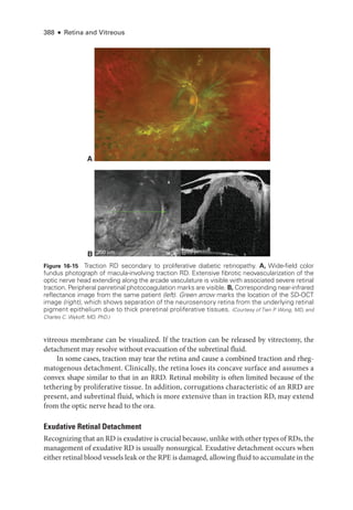 388 ● Retina and Vitreous
vitreous membrane can be visualized. If the traction can be released by vitrectomy, the
detachment may resolve without evacuation of the subret­
i­
nal fluid.
In some cases, traction may tear the ret­
ina and cause a combined traction and rheg­
matogenous detachment. Clinically, the ret­
ina loses its concave surface and assumes a
convex shape similar to that in an RRD. Ret­
i­
nal mobility is often ­
limited ­
because of the
tethering by proliferative tissue. In addition, corrugations characteristic of an RRD are
pre­
sent, and subret­
i­
nal fluid, which is more extensive than in traction RD, may extend
from the optic nerve head to the ora.
Exudative Ret­i­nal Detachment
Recognizing that an RD is exudative is crucial ­because, unlike with other types of RDs, the
management of exudative RD is usually nonsurgical. Exudative detachment occurs when
­either ret­i­nal blood vessels leak or the RPE is damaged, allowing fluid to accumulate in the
A
B 200 μm
200 μm
Figure 16-15 Traction RD secondary to proliferative diabetic retinopathy. A, Wide-­field color
fundus photo­
graph of macula-­
involving traction RD. Extensive fibrotic neovascularization of the
optic nerve head extending along the arcade vasculature is vis­
i­
ble with associated severe ret­
i­
nal
traction. Peripheral panret­
i­
nal photocoagulation marks are vis­
i­
ble. B, Corresponding near-­
infrared
reflectance image from the same patient (left). Green arrow marks the location of the SD-­
OCT
image (right), which shows separation of the neurosensory ret­
ina from the under­
lying retinal
pigment epithelium due to thick preret­
i­
nal proliferative tissues. (Courtesy of Tien P
. Wong, MD, and
Charles C. Wykoff, MD, PhD.)
 