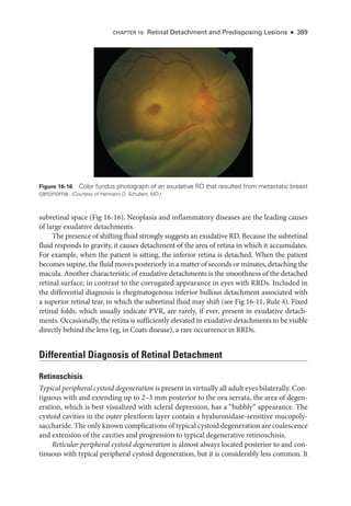 CHAPTER 16: Ret­
i­
nal Detachment and Predisposing Lesions ● 389
subret­i­nal space (Fig 16-16). Neoplasia and inflammatory diseases are the leading ­
causes
of large exudative detachments.
The presence of shifting fluid strongly suggests an exudative RD. ­
Because the subret­
i­
nal
fluid responds to gravity, it ­
causes detachment of the area of ret­
ina in which it accumulates.
For example, when the patient is sitting, the inferior ret­
ina is detached. When the patient
becomes supine, the fluid moves posteriorly in a ­matter of seconds or minutes, detaching the
macula. Another characteristic of exudative detachments is the smoothness of the detached
ret­
i­
nal surface, in contrast to the corrugated appearance in eyes with RRDs. Included in
the differential diagnosis is rhegmatogenous inferior bullous detachment associated with
a superior ret­
i­
nal tear, in which the subret­
i­
nal fluid may shift (see Fig 16-11, Rule 4). Fixed
ret­
i­
nal folds, which usually indicate PVR, are rarely, if ever, pre­
sent in exudative detach­
ments. Occasionally, the ret­
ina is sufficiently elevated in exudative detachments to be vis­
i­
ble
directly ­
behind the lens (eg, in Coats disease), a rare occurrence in RRDs.
Differential Diagnosis of Ret­
i­
nal Detachment
Retinoschisis
Typical peripheral cystoid degeneration is pre­sent in virtually all adult eyes bilaterally. Con­
tiguous with and extending up to 2–3 mm posterior to the ora serrata, the area of degen­
eration, which is best visualized with scleral depression, has a “bubbly” appearance. The
cystoid cavities in the outer plexiform layer contain a hyaluronidase-­
sensitive mucopoly­
saccharide. The only known complications of typical cystoid degeneration are coalescence
and extension of the cavities and progression to typical degenerative retinoschisis.
Reticular peripheral cystoid degeneration is almost always located posterior to and con­
tinuous with typical peripheral cystoid degeneration, but it is considerably less common. It
Figure 16-16 Color fundus photo­
graph of an exudative RD that resulted from metastatic breast
carcinoma. (Courtesy of Hermann D. Schubert, MD.)
 