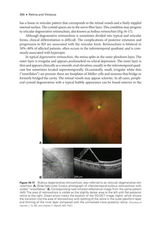 390 ● Retina and Vitreous
has a linear or reticular pattern that corresponds to the ret­
i­
nal vessels and a finely stippled
internal surface. The cystoid spaces are in the nerve fiber layer. This condition may pro­
gress
to reticular degenerative retinoschisis, also known as bullous retinoschisis (Fig 16-17).
Although degenerative retinoschisis is sometimes divided into typical and reticular
forms, clinical differentiation is difficult. The complications of posterior extension and
progression to RD are associated with the reticular form. Retinoschisis is bilateral in
50%–80% of affected patients, often occurs in the inferotemporal quadrant, and is com­
monly associated with hyperopia.
In typical degenerative retinoschisis, the ret­
ina splits in the outer plexiform layer. The
outer layer is irregular and appears pockmarked on scleral depression. The inner layer is
thin and appears clinically as a smooth, oval elevation, usually in the inferotemporal quad­
rant but sometimes located superotemporally. Occasionally, small, irregular white dots
(“snowflakes”) are pre­
sent; ­
these are footplates of Müller cells and neurons that bridge or
formerly bridged the cavity. The ret­
i­
nal vessels may appear sclerotic. In all cases, periph­
eral cystoid degeneration with a typical bubbly appearance can be found anterior to the
A
B 200 μm
Figure 16-17 Bullous degenerative retinoschisis, also referred to as reticular degenerative reti-
noschisis. A, Wide-­
field color fundus photo­
graph of inferotemporal bullous retinoschisis with
vis­i­ble “snowflakes.
” B, Corresponding near-­
infrared reflectance image from the same patient
(left).The area of retinoschisis is vis­
i­
ble as the slightly darker area to the left with flat posterior
ret­
ina to the right. Green arrow marks the location of the SD-­
OCT image (right), which shows
the transition into the area of retinoschisis with splitting of the ret­
ina in the outer plexiform layer
and thinning of the inner layer compared with the uninvolved more posterior ret­
ina. (Courtesy of
Hannah J. Yu, BS, and Charles C. Wykoff, MD, PhD.)
 