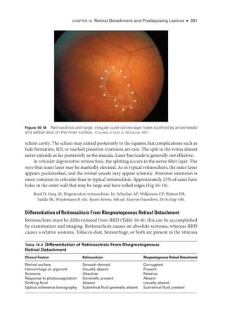 CHAPTER 16: Ret­
i­
nal Detachment and Predisposing Lesions ● 391
schisis cavity. The schisis may extend posteriorly to the equator, but complications such as
hole formation, RD, or marked posterior extension are rare. The split in the ret­
ina almost
never extends as far posteriorly as the macula. ­
Laser barricade is generally not effective.
In reticular degenerative retinoschisis, the splitting occurs in the nerve fiber layer. The
very thin inner layer may be markedly elevated. As in typical retinoschisis, the outer layer
appears pockmarked, and the ret­
i­
nal vessels may appear sclerotic. Posterior extension is
more common in reticular than in typical retinoschisis. Approximately 23% of cases have
holes in the outer wall that may be large and have rolled edges (Fig 16-18).
Reed D, Garg AJ. Degenerative retinoschisis. In: Schachat AP, Wilkinson CP, Hinton DR,
Sadda SR, Wiedemann P, eds. Ryan’s Ret­i­na. 6th ed. Elsevier/Saunders; 2018:chap 100.
Differentiation of Retinoschisis From Rhegmatogenous Ret­
i­
nal Detachment
Retinoschisis must be differentiated from RRD (­Table 16-4); this can be accomplished
by examination and imaging. Retinoschisis ­
causes an absolute scotoma, whereas RRD
­
causes a relative scotoma. Tobacco dust, hemorrhage, or both are pre­
sent in the vitreous
Figure 16-18 Retinoschisis with large, irregular outer-­
schisis-­
layer holes (outlined by arrowheads)
and yellow dots on the inner surface. (Courtesy of Colin A. McCannel, MD.)
­Table 16-4 Differentiation of Retinoschisis From Rhegmatogenous
Ret­i­nal Detachment
Clinical Feature Retinoschisis Rhegmatogenous Ret­i­nal Detachment
Ret­i­nal surface Smooth-­domed Corrugated
Hemorrhage or pigment Usually absent Pre­sent
Scotoma Absolute Relative
Response to photocoagulation Generally pre­sent Absent
Shifting fluid Absent Usually absent
Optical coherence tomography Subret­
i­
nal fluid generally absent Subret­i­nal fluid pre­sent
 