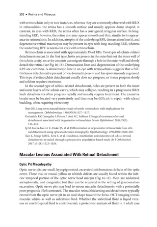 392 ● Retina and Vitreous
with retinoschisis only in rare instances, whereas they are commonly observed with RRD.
In retinoschisis, the ret­
ina has a smooth surface and usually appears dome ­
shaped; in
contrast, in eyes with RRD, the ret­
ina often has a corrugated, irregular surface. In long-­
standing RRD, however, the ret­ina also may appear smooth and thin, similar to its appear­
ance in retinoschisis. In addition, atrophy of the under­lying RPE, demarcation line(s), and
degenerative ret­
i­
nal macrocysts may be pre­
sent in eyes with long-­
standing RRD, whereas
the under­
lying RPE is normal in eyes with retinoschisis.
Retinoschisis is associated with approximately 3% of RDs. Two types of schisis-­related
detachments occur. In the first type, holes are pre­sent in the outer but not the inner wall of
the schisis cavity, so cavity contents can migrate through a hole in the outer wall and slowly
detach the ret­
ina (see Fig 16-18). Demarcation lines and degeneration of the under­
lying
RPE are common. A demarcation line in an eye with retinoschisis suggests that a full-­
thickness detachment is pre­sent or was formerly pre­sent and has spontaneously regressed.
This type of retinoschisis detachment usually does not pro­
gress, or it may pro­
gress slowly
and seldom requires treatment.
In the second type of schisis-­
related detachment, holes are pre­
sent in both the inner
and outer layers of the schisis cavity, which may collapse, resulting in a progressive RRD.
Such detachments often pro­
gress rapidly and usually require treatment. The causative
breaks may be located very posteriorly and thus may be difficult to repair with scleral
buckling, often requiring vitrectomy.
Byer NE. Long-­
term natu­
ral history study of senile retinoschisis with implications for
man­agement. Ophthalmology. 1986;93(9):1127–1137.
Gotzaridis EV, Georgalas I, Petrou P, Assi AC, ­
Sullivan P. Surgical treatment of retinal
detachment associated with degenerative retinoschisis. Semin Ophthalmol. 2014;29(3):​
136–141.
Ip M, Garza-­
Karren C, Duker JS, et al. Differentiation of degenerative retinoschisis from ret­
i­
nal detachment using optical coherence tomography. Ophthalmology. 1999;106(3):600–605.
Xue K, Muqit MMK, Ezra E, et al. Incidence, mechanism and outcomes of schisis ret­
i­
nal
detachments revealed through a prospective population-­
based study. Br J Ophthalmol.
2017;101(8):1022–1026.
Macular Lesions Associated With Ret­
i­
nal Detachment
Optic Pit Maculopathy
Optic nerve pits are small, hypopigmented, excavated colobomatous defects of the optic
nerve. ­
These oval or round, yellow or whitish defects are usually found within the infe­
rior temporal portion of the optic nerve head margin (Fig 16-19). Most are unilateral,
asymptomatic, and congenital, but they can be acquired in the setting of glaucomatous
excavation. Optic nerve pits may lead to serous macular detachments with a potentially
poor prognosis if left untreated. The macular ret­
i­
nal thickening and detachment typically
extend from the optic nerve pit in an oval shape ­
toward the fovea. OCT imaging reveals
macular schisis as well as subret­
i­
nal fluid. ­
Whether the subret­
i­
nal fluid is liquid vitre­
ous or cerebrospinal fluid is controversial; a proteomic analy­
sis of fluid in 1 adult case
 