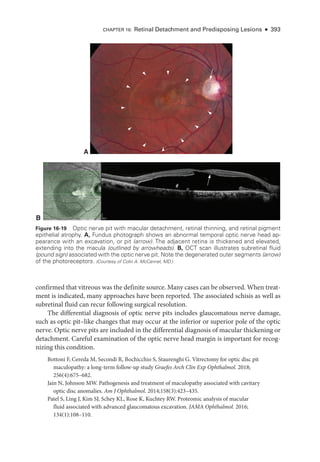CHAPTER 16: Ret­
i­
nal Detachment and Predisposing Lesions ● 393
confirmed that vitreous was the definite source. Many cases can be observed. When treat­
ment is indicated, many approaches have been reported. The associated schisis as well as
subret­
i­
nal fluid can recur following surgical resolution.
The differential diagnosis of optic nerve pits includes glaucomatous nerve damage,
such as optic pit–­
like changes that may occur at the inferior or superior pole of the optic
nerve. Optic nerve pits are included in the differential diagnosis of macular thickening or
detachment. Careful examination of the optic nerve head margin is impor­
tant for recog­
nizing this condition.
Bottoni F, Cereda M, Secondi R, Bochicchio S, Staurenghi G. Vitrectomy for optic disc pit
maculopathy: a long-­
term follow-up study Graefes Arch Clin Exp Ophthalmol. 2018;​
256(4):675–682.
Jain N, Johnson MW. Pathogenesis and treatment of maculopathy associated with cavitary
optic disc anomalies. Am J Ophthalmol. 2014;158(3):423–435.
Patel S, Ling J, Kim SJ, Schey KL, Rose K, Kuchtey RW. Proteomic analy­
sis of macular
fluid associated with advanced glaucomatous excavation. JAMA Ophthalmol. 2016;​
134(1):108–110.
B
#
A
Figure 16-19 Optic nerve pit with macular detachment, ret­
i­
nal thinning, and ret­
i­
nal pigment
epithelial atrophy. A, Fundus photo­
graph shows an abnormal temporal optic nerve head ap-
pearance with an excavation, or pit (arrow). The adjacent ret­
ina is thickened and elevated,
extending into the macula (outlined by arrowheads). B, OCT scan illustrates subret­
i­
nal fluid
(pound sign) associated with the optic nerve pit. Note the degenerated outer segments (arrow)
of the photoreceptors. (Courtesy of Colin A. McCannel, MD.)
 