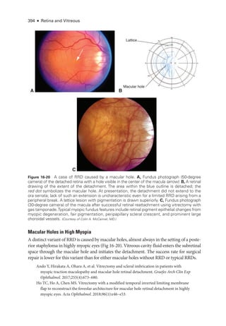394 ● Retina and Vitreous
Macular Holes in High Myopia
A distinct variant of RRD is caused by macular holes, almost always in the setting of a post­
e­
rior staphyloma in highly myopic eyes (Fig 16-20). Vitreous cavity fluid enters the subret­
i­
nal
space through the macular hole and initiates the detachment. The success rate for surgical
repair is lower for this variant than for ­
either macular holes without RRD or typical RRDs.
Ando Y, Hirakata A, Ohara A, et al. Vitrectomy and scleral imbrication in patients with
myopic traction maculopathy and macular hole ret­
i­
nal detachment. Graefes Arch Clin Exp
Ophthalmol. 2017;255(4):673–680.
Ho TC, Ho A, Chen MS. Vitrectomy with a modified temporal inverted limiting membrane
flap to reconstruct the foveolar architecture for macular hole ret­
i­
nal detachment in highly
myopic eyes. Acta Ophthalmol. 2018;96(1):e46–­e53.
C
A B
Macular hole
Lattice
Figure 16-20 A case of RRD caused by a macular hole. A, Fundus photo­
graph (50-­
degree
camera) of the detached ret­
ina with a hole vis­
i­
ble in the center of the macula (arrow). B, A ret­i­nal
drawing of the extent of the detachment. The area within the blue outline is detached; the
red dot symbolizes the macular hole. At pre­
sen­
ta­
tion, the detachment did not extend to the
ora serrata; lack of such an extension is uncharacteristic even for a ­
limited RRD arising from a
peripheral break. A lattice lesion with pigmentation is drawn superiorly. C, Fundus photo­
graph
(30-­
degree camera) of the macula ­
after successful ret­
i­
nal reattachment using vitrectomy with
gas tamponade.Typical myopic fundus features include ret­
i­
nal pigment epithelial changes from
myopic degeneration, fair pigmentation, peripapillary scleral crescent, and prominent large
choroidal vessels. (Courtesy of Colin A. McCannel, MD.)
 