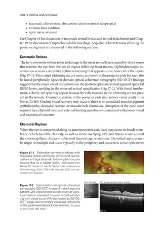 398 ● Retina and Vitreous
• traumatic chorioret­
i­
nal disruption (chorioretinitis sclopetaria)
• vitreous base avulsion
• optic nerve avulsion
See Chapter 16 for discussion of traumatic ret­i­nal breaks and ret­i­nal detachment and Chap-
ter 19 for discussion of suprachoroidal hemorrhage. Sequelae of blunt trauma affecting the
posterior segment are discussed in the following sections.
Commotio Ret­i­nae
The term commotio ret­i­nae refers to damage to the outer ret­
i­
nal layers caused by shock waves
that traverse the eye from the site of impact following blunt trauma. Ophthalmoscopic ex-
amination reveals a sheenlike ret­
i­
nal whitening that appears some hours ­
after the injury
(Fig 17-1). This ret­
i­
nal whitening occurs most commonly in the posterior pole but may also
be found peripherally. Spectral-­
domain optical coherence tomography (SD-­
OCT) findings
suggest that the major site of disruption is in the photoreceptor and ret­
i­
nal pigment epithelial
(RPE) layers, resulting in the observed ret­
i­
nal opacification (Fig 17-2). With foveal involve-
ment, a cherry-­
red spot may appear ­
because the cells involved in the whitening are not pres­
ent in the foveola. Commotio ret­
i­
nae in the posterior pole may reduce visual acuity to as
low as 20/200. Gradual visual recovery may occur if ­
there is no associated macular pigment
epitheliopathy, choroidal rupture, or macular hole formation. Disruption of the cone outer
segment tips, ellipsoid zone, and external limiting membrane is associated with poorer visual
and anatomical outcomes.
Choroidal Rupture
When the eye is compressed along its anteroposterior axis, tears may occur in Bruch mem-
brane, which has ­
little elasticity, as well as in the overlying RPE and fibrous tissue around
the choriocapillaris. Adjacent subret­
i­
nal hemorrhage is common. Choroidal ruptures may
be single or multiple and occur typically in the periphery and concentric to the optic nerve
*
Figure 17-1 Extensive commotio ret­
i­
nae with
sheenlike ret­i­nal whitening (arrow) and preret­
i­
nal hemorrhage (asterisk) following blunt ocular
trauma due to a rubber bullet. (Reproduced from
Barnes AC, Hudson LE, Jain N. Rubber bullet ocular trauma.
Ophthalmology. 2020;127(9):1190. Copyright 2020, with per-
mission from Elsevier.)
IR 30º ART [HS] OCT 30º (8.6 mm) ART (100) Q: 22 [HS]
200 μm
200 μm
Figure 17-2 Spectral-­
domain optical coherence
tomography (SD-­
OCT) image of the left eye of a
patient who experienced a rock injury at work.
Examination revealed macular ret­
i­
nal whiten­
ing with visual acuity (VA) decreased to 20/100.
OCT image demonstrates increased reflectivity
of the parafoveal ellipsoid zone (arrows). (Courtesy
of Shriji Patel, MD, MBA.)
 