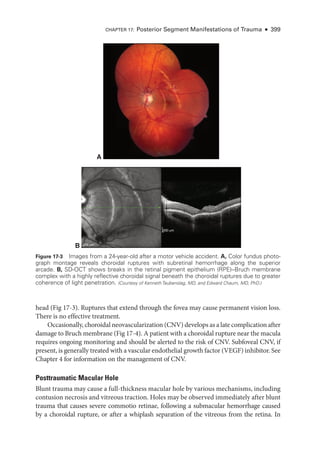 head (Fig 17-3). Ruptures that extend through the fovea may cause permanent vision loss.
­
There is no effective treatment.
Occasionally, choroidal neovascularization (CNV) develops as a late complication ­after
damage to Bruch membrane (Fig 17-4). A patient with a choroidal rupture near the macula
requires ongoing monitoring and should be alerted to the risk of CNV. Subfoveal CNV, if
pre­sent, is generally treated with a vascular endothelial growth ­factor (VEGF) inhibitor. See
Chapter 4 for information on the management of CNV.
Posttraumatic Macular Hole
Blunt trauma may cause a full-­
thickness macular hole by vari­
ous mechanisms, including
contusion necrosis and vitreous traction. Holes may be observed immediately ­
after blunt
trauma that ­
causes severe commotio ret­
i­
nae, following a submacular hemorrhage caused
by a choroidal rupture, or ­
after a whiplash separation of the vitreous from the ret­
ina. In
A
200 μm
200 μm
B
Figure 17-3 Images from a 24-­
year-­
old ­
after a motor vehicle accident. A, Color fundus photo­
graph montage reveals choroidal ruptures with subret­
i­
nal hemorrhage along the superior
arcade. B, SD-­
OCT shows breaks in the ret­
i­
nal pigment epithelium (RPE)–­
Bruch membrane
complex with a highly reflective choroidal signal beneath the choroidal ruptures due to greater
coherence of light penetration. (Courtesy of Kenneth Taubenslag, MD, and Edward Chaum, MD, PhD.)
Chapter 17: Posterior Segment Manifestations of Trauma ● 399
 