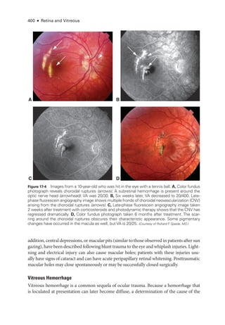 400 ● Retina and Vitreous
addition, central depressions, or macular pits (similar to ­
those observed in patients ­after sun
gazing), have been described following blunt trauma to the eye and whiplash injuries. Light-
ning and electrical injury can also cause macular holes; patients with ­
these injuries usu-
ally have signs of cataract and can have acute peripapillary ret­
i­
nal whitening. Posttraumatic
macular holes may close spontaneously or may be successfully closed surgically.
Vitreous Hemorrhage
Vitreous hemorrhage is a common sequela of ocular trauma. ­
Because a hemorrhage that
is loculated at pre­
sen­
ta­
tion can ­
later become diffuse, a determination of the cause of the
A B
C D
Figure 17-4 Images from a 10-­
year-­
old who was hit in the eye with a tennis ball. A, Color fundus
photo­
graph reveals choroidal ruptures (arrows). A subret­
i­
nal hemorrhage is pre­
sent around the
optic nerve head (arrowhead). VA was 20/30. B, Six weeks ­
later, VA decreased to 20/400. Late-­
phase fluorescein angiography image shows multiple fronds of choroidal neovascularization (CNV)
arising from the choroidal ruptures (arrows). C, Late-­
phase fluorescein angiography image taken
2 weeks ­
after treatment with corticosteroids and photodynamic therapy shows that the CNV has
regressed dramatically. D, Color fundus photo­
graph taken 6 months ­
after treatment. The scar­
ring around the choroidal ruptures obscures their characteristic appearance. Some pigmentary
changes have occurred in the macula as well, but VA is 20/25. (Courtesy of Richard F
. Spaide, MD.)
 