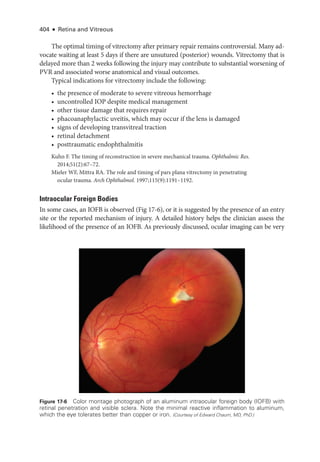 404 ● Retina and Vitreous
The optimal timing of vitrectomy ­
after primary repair remains controversial. Many ad-
vocate waiting at least 5 days if ­
there are unsutured (posterior) wounds. Vitrectomy that is
delayed more than 2 weeks following the injury may contribute to substantial worsening of
PVR and associated worse anatomical and visual outcomes.
Typical indications for vitrectomy include the following:
• the presence of moderate to severe vitreous hemorrhage
• uncontrolled IOP despite medical management
• other tissue damage that requires repair
• phacoanaphylactic uveitis, which may occur if the lens is damaged
• signs of developing transvitreal traction
• ret­i­nal detachment
• posttraumatic endophthalmitis
Kuhn F. The timing of reconstruction in severe mechanical trauma. Ophthalmic Res.
2014;51(2):67–72.
Mieler WF, Mittra RA. The role and timing of pars plana vitrectomy in penetrating
ocular trauma. Arch Ophthalmol. 1997;115(9):1191–1192.
Intraocular Foreign Bodies
In some cases, an IOFB is observed (Fig 17-6), or it is suggested by the presence of an entry
site or the reported mechanism of injury. A detailed history helps the clinician assess the
likelihood of the presence of an IOFB. As previously discussed, ocular imaging can be very
Figure 17-6 Color montage photo­
graph of an aluminum intraocular foreign body (IOFB) with
ret­
i­
nal penetration and vis­
i­
ble sclera. Note the minimal reactive inflammation to aluminum,
which the eye tolerates better than copper or iron. (Courtesy of Edward Chaum, MD, PhD.)
 