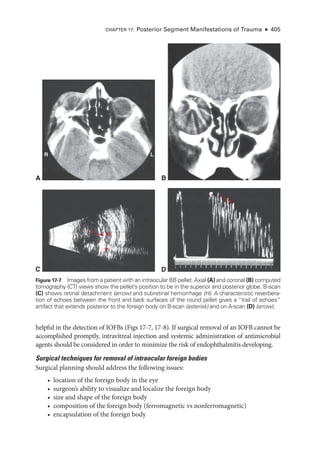 Chapter 17: Posterior Segment Manifestations of Trauma ● 405
helpful in the detection of IOFBs (Figs 17-7, 17-8). If surgical removal of an IOFB cannot be
accomplished promptly, intravitreal injection and systemic administration of antimicrobial
agents should be considered in order to minimize the risk of endophthalmitis developing.
Surgical techniques for removal of intraocular foreign bodies
Surgical planning should address the following issues:
• location of the foreign body in the eye
• surgeon’s ability to visualize and localize the foreign body
• size and shape of the foreign body
• composition of the foreign body (ferromagnetic vs nonferromagnetic)
• encapsulation of the foreign body
A B
C D
R L
H
*
Figure 17-7 Images from a patient with an intraocular BB pellet. Axial (A) and coronal (B) computed
tomography (CT) views show the pellet’s position to be in the superior and posterior globe. B-­
scan
(C) shows ret­
i­
nal detachment (arrow) and subret­
i­
nal hemorrhage (H). A characteristic reverbera­
tion of echoes between the front and back surfaces of the round pellet gives a “trail of echoes”
artifact that extends posterior to the foreign body on B-­
scan (asterisk) and on A-­
scan (D) (arrow).
 