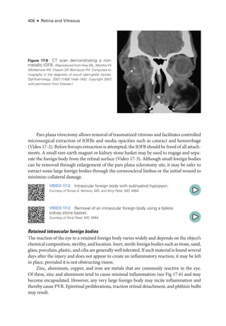 406 ● Retina and Vitreous
Pars plana vitrectomy allows removal of traumatized vitreous and facilitates controlled
microsurgical extraction of IOFBs and media opacities such as cataract and hemorrhage
(Video 17-2). Before forceps extraction is attempted, the IOFB should be freed of all attach-
ments. A small rare-­
earth magnet or kidney stone basket may be used to engage and sepa-
rate the foreign body from the ret­
i­
nal surface (Video 17-3). Although small foreign bodies
can be removed through enlargement of the pars plana sclerotomy site, it may be safer to
extract some large foreign bodies through the corneoscleral limbus or the initial wound to
minimize collateral damage.
VIDEO 17-2 Intraocular foreign body with subhyaloid hypopyon.
Courtesy of Tomas A. Moreno, MD, and Shriji Patel, MD, MBA.
VIDEO 17-3 Removal of an intraocular foreign body using a tipless
kidney stone basket.
Courtesy of Shriji Patel, MD, MBA.
Retained intraocular foreign bodies
The reaction of the eye to a retained foreign body varies widely and depends on the object’s
chemical composition, sterility, and location. Inert, sterile foreign bodies such as stone, sand,
glass, porcelain, plastic, and cilia are generally well tolerated. If such material is found several
days ­
after the injury and does not appear to create an inflammatory reaction, it may be left
in place, provided it is not obstructing vision.
Zinc, aluminum, copper, and iron are metals that are commonly reactive in the eye.
Of ­
these, zinc and aluminum tend to cause minimal inflammation (see Fig 17-6) and may
become encapsulated. However, any very large foreign body may incite inflammation and
thereby cause PVR. Epiret­
i­
nal proliferations, traction ret­
i­
nal detachment, and phthisis bulbi
may result.
Figure 17-8 CT scan demonstrating a non­
metallic IOFB. (Reproduced from Arey ML, Mootha VV,
Whittemore AR, Chason DP
, Blomquist PH. Computed to-
mography in the diagnosis of occult open-­
globe injuries.
Ophthalmology. 2007;114(8):1448–1452. Copyright 2007
,
with permission from Elsevier.)
 