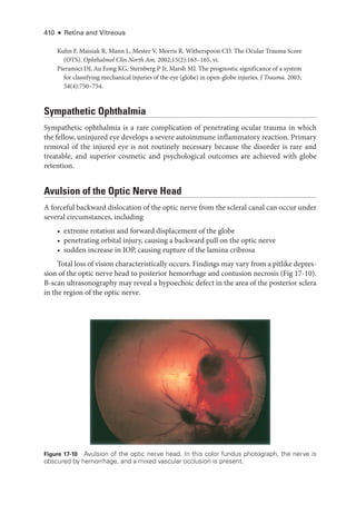 410 ● Retina and Vitreous
Kuhn F, Maisiak R, Mann L, Mester V, Morris R, Witherspoon CD. The Ocular Trauma Score
(OTS). Ophthalmol Clin North Am. 2002;15(2):163–165, vi.
Pieramici DJ, Au Eong KG, Sternberg P Jr, Marsh MJ. The prognostic significance of a system
for classifying mechanical injuries of the eye (globe) in open-­
globe injuries. J Trauma. 2003;​
54(4):750–754.
Sympathetic Ophthalmia
Sympathetic ophthalmia is a rare complication of penetrating ocular trauma in which
the fellow, uninjured eye develops a severe autoimmune inflammatory reaction. Primary
removal of the injured eye is not routinely necessary ­
because the disorder is rare and
treatable, and superior cosmetic and psychological outcomes are achieved with globe
retention.
Avulsion of the Optic Nerve Head
A forceful backward dislocation of the optic nerve from the scleral canal can occur ­
under
several circumstances, including
• extreme rotation and forward displacement of the globe
• penetrating orbital injury, causing a backward pull on the optic nerve
• sudden increase in IOP, causing rupture of the lamina cribrosa
Total loss of vision characteristically occurs. Findings may vary from a pitlike depres-
sion of the optic nerve head to posterior hemorrhage and contusion necrosis (Fig 17-10).
B-­
scan ultrasonography may reveal a hypoechoic defect in the area of the posterior sclera
in the region of the optic nerve.
Figure 17-10 Avulsion of the optic nerve head. In this color fundus photo­
graph, the nerve is
obscured by hemorrhage, and a mixed vascular occlusion is pre­
sent.
 