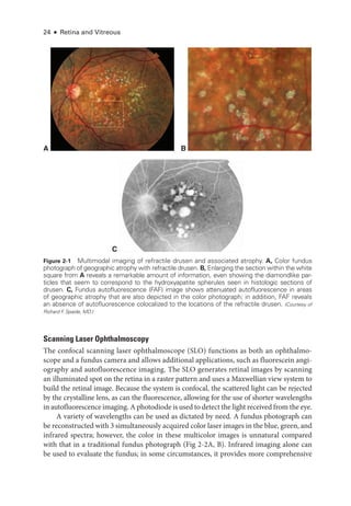 24 ● Retina and Vitreous
Scanning ­
Laser Ophthalmoscopy
The confocal scanning ­
laser ophthalmoscope (SLO) functions as both an ophthalmo-
scope and a fundus camera and allows additional applications, such as fluorescein angi-
ography and autofluorescence imaging. The SLO generates ret­
i­
nal images by scanning
an illuminated spot on the ret­
ina in a raster pattern and uses a Maxwellian view system to
build the ret­
i­
nal image. ­
Because the system is confocal, the scattered light can be rejected
by the crystalline lens, as can the fluorescence, allowing for the use of shorter wavelengths
in autofluorescence imaging. A photodiode is used to detect the light received from the eye.
A variety of wavelengths can be used as dictated by need. A fundus photo­
graph can
be reconstructed with 3 si­mul­ta­neously acquired color ­laser images in the blue, green, and
infrared spectra; however, the color in ­
these multicolor images is unnatural compared
with that in a traditional fundus photo­
graph (Fig 2-2A, B). Infrared imaging alone can
be used to evaluate the fundus; in some circumstances, it provides more comprehensive
A B
C
Figure 2-1 Multimodal imaging of refractile drusen and associated atrophy. A, Color fundus
photo­
graph of geographic atrophy with refractile drusen. B, Enlarging the section within the white
square from A reveals a remarkable amount of information, even showing the diamondlike par­
ticles that seem to correspond to the hydroxyapatite spherules seen in histologic sections of
drusen. C, Fundus autofluorescence (FAF) image shows attenuated autofluorescence in areas
of geographic atrophy that are also depicted in the color photo­
graph; in addition, FAF reveals
an absence of autofluorescence colocalized to the locations of the refractile drusen. (Courtesy of
Richard F
. Spaide, MD.)
 