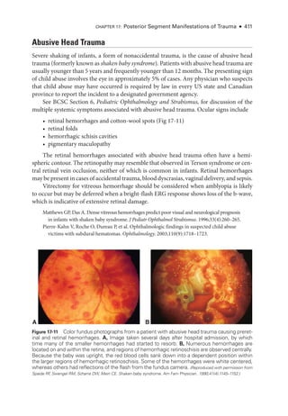 Abusive Head Trauma
Severe shaking of infants, a form of nonaccidental trauma, is the cause of abusive head
trauma (formerly known as shaken baby syndrome). Patients with abusive head trauma are
usually younger than 5 years and frequently younger than 12 months. The presenting sign
of child abuse involves the eye in approximately 5% of cases. Any physician who suspects
that child abuse may have occurred is required by law in ­
every US state and Canadian
province to report the incident to a designated government agency.
See BCSC Section 6, Pediatric Ophthalmology and Strabismus, for discussion of the
multiple systemic symptoms associated with abusive head trauma. Ocular signs include
• ret­
i­
nal hemorrhages and cotton-­
wool spots (Fig 17-11)
• ret­i­nal folds
• hemorrhagic schisis cavities
• pigmentary maculopathy
The ret­
i­
nal hemorrhages associated with abusive head trauma often have a hemi-
spheric contour. The retinopathy may resemble that observed in Terson syndrome or cen-
tral ret­
i­
nal vein occlusion, neither of which is common in infants. Ret­
i­
nal hemorrhages
may be pre­sent in cases of accidental trauma, blood dyscrasias, vaginal delivery, and sepsis.
Vitrectomy for vitreous hemorrhage should be considered when amblyopia is likely
to occur but may be deferred when a bright-­
flash ERG response shows loss of the b-­
wave,
which is indicative of extensive ret­
i­
nal damage.
Matthews GP, Das A. Dense vitreous hemorrhages predict poor visual and neurological prognosis
in infants with shaken baby syndrome. J Pediatr Ophthalmol Strabismus. 1996;33(4):260–265.
Pierre-­
Kahn V, Roche O, Dureau P, et al. Ophthalmologic findings in suspected child abuse
victims with subdural hematomas. Ophthalmology. 2003;110(9):1718–1723.
A B
Figure 17-11 Color fundus photo­
graphs from a patient with abusive head trauma causing preret­
i­nal and ret­i­nal hemorrhages. A, Image taken several days ­
after hospital admission, by which
time many of the smaller hemorrhages had started to resorb. B, Numerous hemorrhages are
located on and within the ret­
ina, and regions of hemorrhagic retinoschisis are observed centrally.
­
Because the baby was upright, the red blood cells sank down into a dependent position within
the larger regions of hemorrhagic retinoschisis. Some of the hemorrhages ­
were white centered,
whereas ­
others had reflections of the flash from the fundus camera. (Reproduced with permission from
Spaide RF
, Swengel RM, Scharre DW, Mein CE. Shaken baby syndrome. Am Fam Physician. 1990;41(4):1145–1152.)
Chapter 17: Posterior Segment Manifestations of Trauma ● 411
 