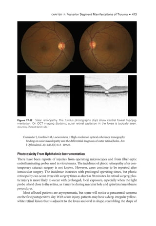 Comander J, Gardiner M, Loewenstein J. High-­
resolution optical coherence tomography
findings in solar maculopathy and the differential diagnosis of outer ret­
i­
nal holes. Am
J Ophthalmol. 2011;152(3):413–419.e6.
Phototoxicity From Ophthalmic Instrumentation
­
There have been reports of injuries from operating microscopes and from fiber-­
optic
endoilluminating probes used in vitrectomies. The incidence of photic retinopathy ­
after con­
temporary cataract surgery is not known. However, cases continue to be reported ­
after
intraocular surgery. The incidence increases with prolonged operating times, but photic
retinopathy can occur even with surgery times as short as 30 minutes. In ret­i­nal surgery, pho-
tic injury is more likely to occur with prolonged, focal exposure, especially when the light
probe is held close to the ret­ina, as it may be during macular hole and epiret­i­nal membrane
procedures.
Most affected patients are asymptomatic, but some ­
will notice a paracentral scotoma
on the first postoperative day. With acute injury, patients may have a deep, irregular yellow-­
white ret­
i­
nal lesion that is adjacent to the fovea and oval in shape, resembling the shape of
Figure 17-12 Solar retinopathy. The fundus photo­
graphs (top) show central foveal hypopig­
mentation. On OCT imaging (bottom), outer ret­
i­
nal cavitation in the fovea is typically seen.
(Courtesy of David Sarraf, MD.)
Chapter 17: Posterior Segment Manifestations of Trauma ● 413
 