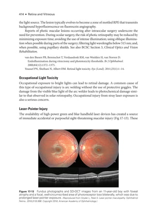 414 ● Retina and Vitreous
the light source. The lesion typically evolves to become a zone of mottled RPE that transmits
background hyperfluorescence on fluorescein angiography.
Reports of photic macular lesions occurring ­
after intraocular surgery underscore the
need for prevention. During ocular surgery, the risk of photic retinopathy may be reduced by
minimizing exposure time; avoiding the use of intense illumination; using oblique illumina-
tion when pos­si­ble during parts of the surgery; filtering light wavelengths below 515 nm; and,
when pos­
si­
ble, using pupillary shields. See also BCSC Section 3, Clinical Optics and Vision
Rehabilitation.
van den Biesen PR, Berenschot T, Verdaasdonk RM, van Weelden H, van Norren D.
Endoillumination during vitrectomy and phototoxicity thresholds. Br J Ophthalmol.
2000;84(12):1372–1375.
Youssef PN, Sheibani N, Albert DM. Ret­
i­
nal light toxicity. Eye (Lond). 2011;25(1):1–14.
Occupational Light Toxicity
Occupational exposure to bright lights can lead to ret­
i­
nal damage. A common cause of
this type of occupational injury is arc welding without the use of protective goggles. The
damage from the vis­
i­
ble blue light of the arc welder leads to photochemical damage simi-
lar to that observed in solar retinopathy. Occupational injury from stray ­
laser exposure is
also a serious concern.
Laser-­Pointer Injury
The availability of high-­
power green and blue handheld ­
laser devices has created a source
of immediate accidental or purposeful sight-­
threatening macular injury (Fig 17-13). ­These
Figure 17-13 Fundus photo­
graphs and SD-­
OCT images from an 11-­
year-­
old boy with foveal
atrophy and a focal, well-­
circumscribed area of photoreceptor loss bilaterally, which was due to
prolonged laser-­
pointer exposure. (Reproduced from Snyder L, Patel S. ­
Laser pointer maculopathy. Ophthalmol
Ret­i­na. 2018;2(10):996. Copyright 2018, American Academy of Ophthalmology.)
 