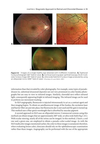 Chapter 2: Diagnostic Approach to Ret­
i­
nal and Choroidal Disease ● 25
information than that revealed by color photography. For example, some types of pseudo-
drusen (ie, subret­
i­
nal drusenoid deposits) are not very prominent in color fundus photo­
graphs but are easy to view in infrared images. Similarly, choroidal nevi reflect infrared
light, consequently appearing bright in infrared imaging. The infrared image can be used
to perform eye movement tracking.
In SLO angiography, fluorescein is injected intravenously to act as a contrast agent and
then imaging begins. To obtain an autofluorescent image of the fundus, the excitation ­
laser
and barrier filter are put into place, but fluorescein dye is not used and the gain is turned up.
This method uses a blue-­
green wavelength that is absorbed by macular pigment.
A second approach to SLO uses an ellipsoidal mirror. Commercial systems using this
method can obtain images that are approximately 200° wide, or ultra wide field (Fig 2-2C).
With ocular steering, nearly all of the ret­
ina can be imaged. In this method, 2 ­
lasers, a red
one and a green one, are employed to obtain a pseudo–­
color-­
scaled image. As with the
SLO multicolor images mentioned ­earlier, the color in ­these images is unnatural; therefore,
when evaluating lesion color, clinicians should rely on the ophthalmoscopic examination
rather than ­
these images. Angiography can be performed with the use of the appropriate
Figure 2-2 Images of a single healthy eye obtained with 3 dif­
fer­
ent modalities. A, Traditional
fundus photo­
graph (50° field of view). B, Confocal scanning ­
laser ophthalmoscopy (SLO) multi­
color fundus image (30° field of view). C, Ultra-­
wide-­
field SLO fundus image produced by using
an ellipsoidal mirror (200° field of view). (Courtesy of Lucia Sobrin, MD.)
C
A B
 