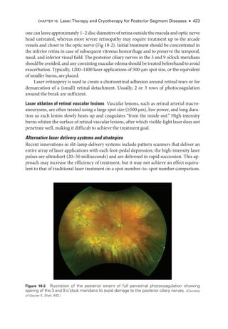 one can leave approximately 1–2 disc dia­meters of ret­ina outside the macula and optic nerve
head untreated, whereas more severe retinopathy may require treatment up to the arcade
vessels and closer to the optic nerve (Fig 18-2). Initial treatment should be concentrated in
the inferior ret­
ina in case of subsequent vitreous hemorrhage and to preserve the temporal,
nasal, and inferior visual field. The posterior ciliary nerves in the 3 and 9 ­
o’clock meridians
should be avoided, and any coexisting macular edema should be treated beforehand to avoid
exacerbation. Typically, 1200–1400 ­
laser applications of 500-­
µm spot size, or the equivalent
of smaller burns, ­
are placed.
­
Laser retinopexy is used to create a chorioret­
i­
nal adhesion around ret­
i­
nal tears or for
demarcation of a (small) ret­
i­
nal detachment. Usually, 2 or 3 rows of photocoagulation
around the break are sufficient.
­
Laser ablation of ret­
i­
nal vascular lesions ​
Vascular lesions, such as ret­
i­
nal arterial macro-
aneurysms, are often treated using a large spot size (≥500 µm), low power, and long dura­
tion so each lesion slowly heats up and coagulates “from the inside out.” High-­
intensity
burns whiten the surface of ret­i­nal vascular lesions, ­after which visible-­light ­laser does not
penetrate well, making it difficult to achieve the treatment goal.
Alternative ­
laser delivery systems and strategies
Recent innovations in slit-­
lamp delivery systems include pattern scanners that deliver an
entire array of ­
laser applications with each foot-­
pedal depression; the high-­
intensity ­
laser
pulses are ultrashort (20–50 milliseconds) and are delivered in rapid succession. This ap­
proach may increase the efficiency of treatment, but it may not achieve an effect equiva­
lent to that of traditional ­
laser treatment on a spot number–­
to–­
spot number comparison.
Figure 18-2 Illustration of the posterior extent of full panret­
i­
nal photocoagulation showing
sparing of the 3 and 9 ­
o’clock meridians to avoid damage to the posterior ciliary nerves. (Courtesy
of Gaurav K. Shah, MD.)
CHAPTER 18: ­
Laser Therapy and Cryotherapy for Posterior Segment Diseases ● 423
 