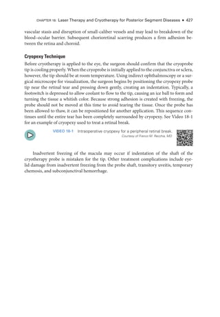 vascular stasis and disruption of small-­
caliber vessels and may lead to breakdown of the
blood–­
ocular barrier. Subsequent chorioret­
i­
nal scarring produces a firm adhesion be­
tween the ret­
ina and choroid.
Cryopexy Technique
Before cryotherapy is applied to the eye, the surgeon should confirm that the cryoprobe
tip is cooling properly. When the cryoprobe is initially applied to the conjunctiva or sclera,
however, the tip should be at room temperature. Using indirect ophthalmoscopy or a sur­
gical microscope for visualization, the surgeon begins by positioning the cryopexy probe
tip near the ret­
i­
nal tear and pressing down ­
gently, creating an indentation. Typically, a
footswitch is depressed to allow coolant to flow to the tip, causing an ice ball to form and
turning the tissue a whitish color. ­
Because strong adhesion is created with freezing, the
probe should not be moved at this time to avoid tearing the tissue. Once the probe has
been allowed to thaw, it can be repositioned for another application. This sequence con­
tinues ­
until the entire tear has been completely surrounded by cryopexy. See Video 18-1
for an example of cryopexy used to treat a ret­
i­
nal break.
VIDEO 18-1 Intraoperative cryopexy for a peripheral ret­
i­
nal break.
Courtesy of Franco M. Recchia, MD.
Inadvertent freezing of the macula may occur if indentation of the shaft of the
cryotherapy probe is mistaken for the tip. Other treatment complications include eye­
lid damage from inadvertent freezing from the probe shaft, transitory uveitis, temporary
chemosis, and subconjunctival hemorrhage.
CHAPTER 18: ­
Laser Therapy and Cryotherapy for Posterior Segment Diseases ● 427
 
