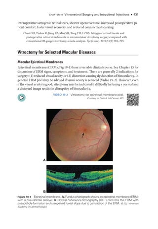 Chapter 19: Vitreoret­
i­
nal Surgery and Intravitreal Injections ● 431
intraoperative iatrogenic ret­
i­
nal tears, shorter operative time, increased postoperative pa-
tient comfort, faster visual recovery, and reduced conjunctival scarring.
Chen GH, Tzekov R, Jiang FZ, Mao SH, Tong YH, Li WS. Iatrogenic ret­
i­
nal breaks and
postoperative ret­
i­
nal detachments in microincision vitrectomy surgery compared with
conventional 20-­
gauge vitrectomy: a meta-­
analysis. Eye (Lond). 2019;33(5):785–795.
Vitrectomy for Selected Macular Diseases
Macular Epiret­i­nal Membranes
Epiret­i­nal membranes (ERMs; Fig 19-1) have a variable clinical course. See Chapter 15 for
discussion of ERM signs, symptoms, and treatment. ­
There are generally 2 indications for
surgery: (1) reduced visual acuity or (2) distortion causing dysfunction of binocularity. In
general, ERM peel may be advised if visual acuity is reduced (Video 19-2). However, even
if the visual acuity is good, vitrectomy may be indicated if difficulty in fusing a normal and
a distorted image results in disruption of binocularity.
VIDEO 19-2 Vitrectomy for epiret­
i­
nal membrane peel.
Courtesy of Colin A. McCannel, MD.
A
B
Figure 19-1 Epiretinal membrane. A, Fundus photo­
graph shows an epiret­
i­
nal membrane (ERM)
with a pseudohole (arrow). B, Optical coherence tomography (OCT) confirms the ERM with
pseudohole formation and steepened foveal slope due to contraction of the ERM. (© 2021 American
Acad­
emy of Ophthalmology.)
 
