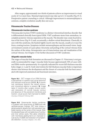 432 ● Retina and Vitreous
­
After surgery, approximately two-­
thirds of patients achieve an improvement in visual
acuity of 2 or more lines. Maximal improvement may take up to 6–12 months (Fig 19-2).
Preoperative patient counseling is critical. Although improvement in metamorphopsia is
common, complete resolution usually does not occur.
Vitreomacular Traction Diseases
Vitreomacular traction syndrome
Vitreomacular traction (VMT) syndrome is a distinct vitreoret­
i­
nal interface disorder that
is differentiated clinically from typical ERM. VMT syndrome stems from anomalous, in-
complete posterior vitreous separation at the macula. The disorder may create focal eleva-
tion of the fovea (Fig 19-3) and, occasionally, a shallow ret­
i­
nal detachment. Classically, in
eyes with this syndrome, the hyaloid tightly inserts into the macula, usually at or near the
fovea, creating traction. Symptoms include metamorphopsia and decreased vision. Surgi-
cal treatment consists of a pars plana vitrectomy and peeling of the cortical vitreous from
the surface of the ret­
ina. Intraoperative use of triamcinolone may aid visualization of the
cortical vitreous. See Chapter 15 for further discussion of VMT syndrome.
Idiopathic macular holes
The stages of macular hole formation are discussed in Chapter 15. Vitrectomy is not gen-
erally recommended for stage 1 macular holes ­
because approximately 50% of cases with-
out ERMs resolve spontaneously. It is typically indicated for recent full-­
thickness macular
holes (stages 2, 3, and 4). Early intervention for full-­
thickness macular holes is impor­
tant;
shorter time between the development and the closure of a macular hole has been associ-
ated with improved anatomical and functional outcomes.
A
B
Figure 19-2 OCT images of an ERM forming
a pseudohole in a patient with visual distortion
and reduced visual acuity (20/50). A, A preret­
i­
nal membrane distorts the ret­
i­
nal contour,
and intraret­
i­
nal edema is pre­
sent. B, Image
taken 2 months ­
after surgery shows contin-
ued restoration of normal macular contour
and absence of the preret­
i­
nal membrane and
traction; visual acuity had improved to 20/25.
(Courtesy of Edward F
. Cherney, MD.)
Figure 19-3 Vitreomacular traction syndrome
in a patient with visual acuity of 20/60 and mild
ophthalmoscopic findings. OCT scan shows a
partial posterior detachment with per­
sis­
tent hya-
loidal insertion at the center of the macula. Note
the elevated fovea with complete loss of contour
and inner schisis cavity. Pars plana vitrectomy
with membrane peeling led to an improved vi-
sual acuity of 20/25 and resolution of symptom-
atic distortion. (Courtesy of Stephen J. Kim, MD.)
 