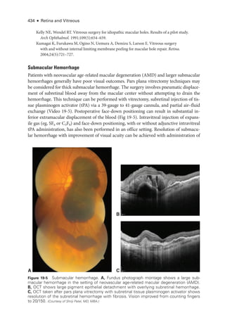 434 ● Retina and Vitreous
Kelly NE, Wendel RT. Vitreous surgery for idiopathic macular holes. Results of a pi­
lot study.
Arch Ophthalmol. 1991;109(5):654–659.
Kumagai K, Furukawa M, Ogino N, Uemura A, Demizu S, Larson E. Vitreous surgery
with and without internal limiting membrane peeling for macular hole repair. Ret­i­na.
2004;24(5):721–727.
Submacular Hemorrhage
Patients with neovascular age-­
related macular degeneration (AMD) and larger submacular
hemorrhages generally have poor visual outcomes. Pars plana vitrectomy techniques may
be considered for thick submacular hemorrhage. The surgery involves pneumatic displace-
ment of subret­
i­
nal blood away from the macular center without attempting to drain the
hemorrhage. This technique can be performed with vitrectomy, subret­
i­
nal injection of tis-
sue plasminogen activator (tPA) via a 39-­
gauge to 41-­
gauge cannula, and partial air–­
fluid
exchange (Video 19-5). Postoperative face-­
down positioning can result in substantial in-
ferior extramacular displacement of the blood (Fig 19-5). Intravitreal injection of expans-
ile gas (eg, SF6 or C3F8) and face-­
down positioning, with or without adjunctive intravitreal
tPA administration, has also been performed in an office setting. Resolution of submacu-
lar hemorrhage with improvement of visual acuity can be achieved with administration of
C
A
B
Figure 19-5 Submacular hemorrhage. A, Fundus photo­
graph montage shows a large sub-
macular hemorrhage in the setting of neovascular age-­
related macular degeneration (AMD).
B, OCT shows large pigment epithelial detachment with overlying subret­
i­
nal hemorrhage.
C, OCT taken ­
after pars plana vitrectomy with subret­
i­
nal tissue plasminogen activator shows
resolution of the subret­
i­
nal hemorrhage with fibrosis. Vision improved from counting fin­
gers
to 20/150. (Courtesy of Shriji Patel, MD, MBA.)
 
