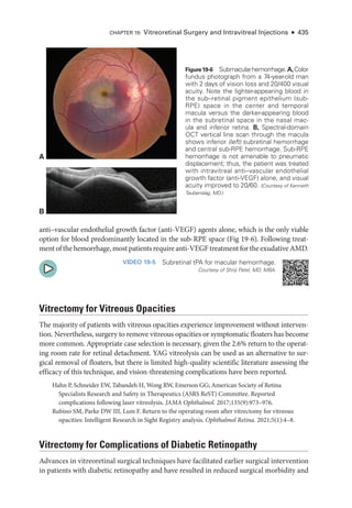Chapter 19: Vitreoret­
i­
nal Surgery and Intravitreal Injections ● 435
A
B
Figure19-6 Submacularhemorrhage.A,Color
fundus photo­
graph from a 74-­
year-­
old man
with 2 days of vision loss and 20/400 visual
acuity. Note the lighter-­
appearing blood in
the sub–­
retinal pigment epithelium (sub-­
RPE) space in the center and temporal
macula versus the darker-­
appearing blood
in the subret­
i­
nal space in the nasal mac-
ula and inferior ret­
ina. B, Spectral-­domain
OCT vertical line scan through the macula
shows inferior (left) subret­i­nal hemorrhage
and central sub-­
RPE hemorrhage. Sub-­
RPE
hemorrhage is not amenable to pneumatic
displacement; thus, the patient was treated
with intravitreal anti–­
vascular endothelial
growth ­
factor (anti-­
VEGF) alone, and visual
acuity improved to 20/60. (Courtesy of Kenneth
Taubenslag, MD.)
anti–­
vascular endothelial growth ­
factor (anti-­
VEGF) agents alone, which is the only ­
viable
option for blood predominantly located in the sub-­
RPE space (Fig 19-6). Following treat-
mentofthehemorrhage,mostpatientsrequireanti-­VEGFtreatmentfortheexudativeAMD.
VIDEO 19-5 Subretinal tPA for macular hemorrhage.
Courtesy of Shriji Patel, MD, MBA.
Vitrectomy for Vitreous Opacities
The majority of patients with vitreous opacities experience improvement without interven-
tion. Nevertheless, surgery to remove vitreous opacities or symptomatic floaters has become
more common. Appropriate case se­
lection is necessary, given the 2.6% return to the operat-
ing room rate for ret­
i­
nal detachment. YAG vitreolysis can be used as an alternative to sur-
gical removal of floaters, but ­
there is ­
limited high-­
quality scientific lit­
er­
a­
ture assessing the
efficacy of this technique, and vision-­
threatening complications have been reported.
Hahn P, Schneider EW, Tabandeh H, Wong RW, Emerson GG; American Society of ­
Retina
Specialists Research and Safety in Therapeutics (ASRS ReST) Committee. Reported
complications following ­
laser vitreolysis. JAMA Ophthalmol. 2017;135(9):973–976.
Rubino SM, Parke DW III, Lum F. Return to the operating room ­
after vitrectomy for vitreous
opacities: Intelligent Research in Sight Registry analy­
sis. Ophthalmol Ret­i­na. 2021;5(1):4–8.
Vitrectomy for Complications of Diabetic Retinopathy
Advances in vitreoret­
i­
nal surgical techniques have facilitated ­
earlier surgical intervention
in patients with diabetic retinopathy and have resulted in reduced surgical morbidity and
 