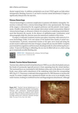 436 ● Retina and Vitreous
shorter surgical times. In addition, preoperative use of anti-­
VEGF agents can help reduce
intraoperative bleeding; however, it can lead to traction ret­
i­
nal detachment if surgery is
significantly delayed ­
after the injection.
Vitreous Hemorrhage
Vitreous hemorrhage is a common complication in patients with diabetic retinopathy. Vit-
rectomy is indicated when a vitreous hemorrhage fails to clear spontaneously. The timing
of the surgery is determined by the surgeon’s preference and the patient’s visual require-
ments. Pos­
si­
ble indications for more prompt intervention include monocularity, bilateral
vitreous hemorrhages, or ultrasonic evidence of a ret­
i­
nal tear or under­
lying ret­
i­
nal detach-
ment that threatens the macula. In the absence of ophthalmoscopic visualization, serial
ultrasonography helps the clinician assess the anatomical condition of the ret­
ina.
If surgery is indicated, treatment involves pars plana vitrectomy with removal of vit-
reous hemorrhage (Video 19-6) and release of the hyaloid from fronds of ret­
i­
nal neo-
vascularization. If pre­
sent, vitreoret­
i­
nal traction at the optic nerve head and along the
arcade vessels is addressed at the time of surgery, along with any macular ERMs. Complete
panret­i­nal photocoagulation and hemostasis should generally be achieved during the pro-
cedure. To prevent bleeding or rebleeding, the eye may be filled with air or a short-­
acting
gas to tamponade pos­
si­
ble bleeding sites.
VIDEO 19-6 Vitrectomy for vitreous hemorrhage.
Courtesy of Colin A. McCannel, MD.
Diabetic Traction Ret­
i­
nal Detachment
Traction(alsocalledtractional)ret­i­naldetachment(TRD)occurswhenthehyaloidcontracts
but fronds of neovascular ingrowth prevent it from separating from the ret­
i­
nal interface.
The tractional forces are transmitted to full-­
thickness ret­
ina and, in the absence of a ret­
i­
nal
break, cause schisis and/or detachment of the under­
lying ret­
ina from the corresponding
RPE (Fig 19-7). Vitrectomy is indicated when progression of a TRD threatens or involves the
macula. In certain complex cases, spontaneous breaks can also occur in an atrophic ret­
ina
­under traction, resulting in combined traction and rhegmatogenous detachments. Although
Figure 19-7 Traction ret­
i­
nal detachment in a
patient with proliferative diabetic retinopathy.
Fibrosis with extensive neovascularization
can be seen along the superior and inferior
­
arcades.­
There is vitreous and preret­
i­
nal hem-
orrhage along with sclerotic vessels tempo-
rally. (Courtesy of Shriji Patel, MD, MBA.)
 