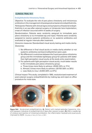 Chapter 19: Vitreoret­
i­
nal Surgery and Intravitreal Injections ● 439
CLINICAL TRIAL 19-1
Endophthalmitis Vitrectomy Study
Objective: To evaluate the role of pars plana vitrectomy and intravenous
antibiotics in the management of postoperative bacterial endophthalmitis.
Participants: Patients with clinical signs and symptoms of bacterial endoph­
thalmitis in an eye ­
after cataract surgery or intraocular lens implantation;
onset of infection occurred within 6 weeks of surgery.
Randomization: Patients ­
were randomly assigned to immediate pars
plana vitrectomy or to immediate tap and inject. Patients ­
were randomly
assigned to receive systemic antibiotics or no systemic antibiotics and
evaluated at regular intervals ­
after treatment.
Outcome mea­sures: Standardized visual acuity testing and media clarity.
Outcomes:
1. No difference in final visual acuity or media clarity ­
whether or not
systemic antibiotics (amikacin/ceftazidime) ­
were used.
2. No difference in outcomes between the 3-­port pars plana vitrectomy
group and the immediate tap/biopsy group for patients with better
than light perception visual acuity at the study entry examination.
3. For patients with light perception visual acuity, much better results
in the immediate pars plana vitrectomy group:
a.	Three times more likely to achieve ≥20/40 (33% vs 11%)
b. Almost 2 times more likely to achieve ≥20/100 (56% vs 30%)
c. Less likely to incur 5/200 (20% vs 47%)
Clinical impact: This study, completed in 1995, revolutionized treatment of
post–­
cataract surgery endophthalmitis by making tap and inject an office
procedure for most eyes.
A B
Figure 19-8 Acute-­onset endophthalmitis. A, Patient with marked epibulbar hyperemia, iritis,
and hypopyon indicative of endophthalmitis 5 days ­
after cataract surgery. B, ­
After a needle tap
of vitreous and injection of intravitreal antibiotics, the inflammation resolved and visual acuity
improved to 20/30. (Courtesy of Harry W. Flynn Jr, MD.)
 