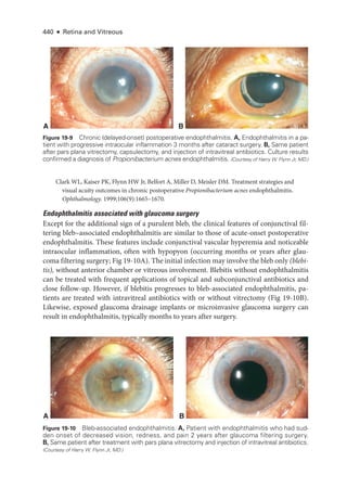 440 ● Retina and Vitreous
Clark WL, Kaiser PK, Flynn HW Jr, Belfort A, Miller D, Meisler DM. Treatment strategies and
visual acuity outcomes in chronic postoperative Propionibacterium acnes endophthalmitis.
Ophthalmology. 1999;106(9):1665–1670.
Endophthalmitis associated with glaucoma surgery
Except for the additional sign of a purulent bleb, the clinical features of conjunctival fil-
tering bleb–­
associated endophthalmitis are similar to ­
those of acute-­
onset postoperative
endophthalmitis. ­
These features include conjunctival vascular hyperemia and noticeable
intraocular inflammation, often with hypopyon (occurring months or years ­
after glau-
coma filtering surgery; Fig 19-10A). The initial infection may involve the bleb only (blebi-
tis), without anterior chamber or vitreous involvement. Blebitis without endophthalmitis
can be treated with frequent applications of topical and subconjunctival antibiotics and
close follow-up. However, if blebitis progresses to bleb-­
associated endophthalmitis, pa-
tients are treated with intravitreal antibiotics with or without vitrectomy (Fig 19-10B).
Likewise, exposed glaucoma drainage implants or microinvasive glaucoma surgery can
result in endophthalmitis, typically months to years ­
after surgery.
A B
Figure 19-9 Chronic (delayed-­
onset) postoperative endophthalmitis. A, Endophthalmitis in a pa-
tient with progressive intraocular inflammation 3 months ­
after cataract surgery. B, Same patient
­
after pars plana vitrectomy, capsulectomy, and injection of intravitreal antibiotics. Culture results
confirmed a diagnosis of Propionibacterium acnes endophthalmitis. (Courtesy of Harry W. Flynn Jr, MD.)
A B
Figure 19-10 Bleb-­associated endophthalmitis. A, Patient with endophthalmitis who had sud-
den onset of decreased vision, redness, and pain 2 years ­
after glaucoma filtering surgery.
B, Same patient ­
after treatment with pars plana vitrectomy and injection of intravitreal antibiotics.
(Courtesy of Harry W. Flynn Jr, MD.)
 