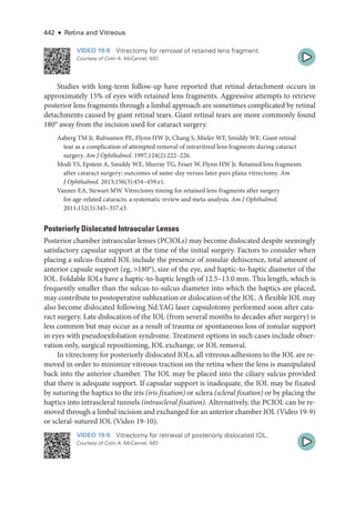 442 ● Retina and Vitreous
VIDEO 19-8 Vitrectomy for removal of retained lens fragment.
Courtesy of Colin A. McCannel, MD.
Studies with long-­
term follow-up have reported that ret­
i­
nal detachment occurs in
approximately 15% of eyes with retained lens fragments. Aggressive attempts to retrieve
posterior lens fragments through a limbal approach are sometimes complicated by ret­
i­
nal
detachments caused by ­
giant ret­
i­
nal tears. ­
Giant ret­
i­
nal tears are more commonly found
180° away from the incision used for cataract surgery.
Aaberg TM Jr, Rubsamen PE, Flynn HW Jr, Chang S, Mieler WF, Smiddy WE. ­
Giant ret­
i­
nal
tear as a complication of attempted removal of intravitreal lens fragments during cataract
surgery. Am J Ophthalmol. 1997;124(2):222–226.
Modi YS, Epstein A, Smiddy WE, Murray TG, Feuer W, Flynn HW Jr. Retained lens fragments
­
after cataract surgery: outcomes of same-­
day versus ­
later pars plana vitrectomy. Am
J Ophthalmol. 2013;156(3):454–459.e1.
Vanner EA, Stewart MW. Vitrectomy timing for retained lens fragments ­
after surgery
for age-­
related cataracts: a systematic review and meta-­
analysis. Am J Ophthalmol.
2011;152(3):345–357.e3.
Posteriorly Dislocated Intraocular Lenses
Posterior chamber intraocular lenses (PCIOLs) may become dislocated despite seemingly
satisfactory capsular support at the time of the initial surgery. ­
Factors to consider when
placing a sulcus-­
fixated IOL include the presence of zonular dehiscence, total amount of
anterior capsule support (eg, 180°), size of the eye, and haptic-­
to-­
haptic dia­
meter of the
IOL. Foldable IOLs have a haptic-­
to-­
haptic length of 12.5–13.0 mm. This length, which is
frequently smaller than the sulcus-­
to-­
sulcus dia­
meter into which the haptics are placed,
may contribute to postoperative subluxation or dislocation of the IOL. A flexible IOL may
also become dislocated following Nd:YAG ­
laser capsulotomy performed soon ­
after cata-
ract surgery. Late dislocation of the IOL (from several months to de­
cades ­
after surgery) is
less common but may occur as a result of trauma or spontaneous loss of zonular support
in eyes with pseudoexfoliation syndrome. Treatment options in such cases include obser-
vation only, surgical repositioning, IOL exchange, or IOL removal.
In vitrectomy for posteriorly dislocated IOLs, all vitreous adhesions to the IOL are re-
moved in order to minimize vitreous traction on the ret­
ina when the lens is manipulated
back into the anterior chamber. The IOL may be placed into the ciliary sulcus provided
that ­
there is adequate support. If capsular support is inadequate, the IOL may be ­
fixated
by suturing the haptics to the iris (iris fixation) or sclera (scleral fixation) or by placing the
haptics into intrascleral tunnels (intrascleral fixation). Alternatively, the PCIOL can be re-
moved through a limbal incision and exchanged for an anterior chamber IOL (Video 19-9)
or scleral-­
sutured IOL (Video 19-10).
VIDEO 19-9 Vitrectomy for retrieval of posteriorly dislocated IOL.
Courtesy of Colin A. McCannel, MD.
 