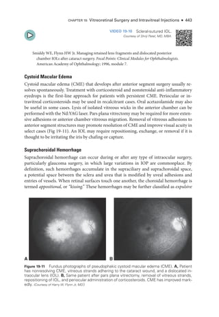 Chapter 19: Vitreoret­
i­
nal Surgery and Intravitreal Injections ● 443
VIDEO 19-10 Scleral-­sutured IOL.
Courtesy of Shriji Patel, MD, MBA.
Smiddy WE, Flynn HW Jr. Managing retained lens fragments and dislocated posterior
chamber IOLs ­
after cataract surgery. Focal Points: Clinical Modules for Ophthalmologists.
American Acad­
emy of Ophthalmology; 1996, module 7.
Cystoid Macular Edema
Cystoid macular edema (CME) that develops ­
after anterior segment surgery usually re-
solves spontaneously. Treatment with corticosteroid and nonsteroidal anti-­
inflammatory
eyedrops is the first-­
line approach for patients with per­
sis­
tent CME. Periocular or in-
travitreal corticosteroids may be used in recalcitrant cases. Oral acetazolamide may also
be useful in some cases. Lysis of isolated vitreous wicks in the anterior chamber can be
performed with the Nd:YAG ­
laser. Pars plana vitrectomy may be required for more exten-
sive adhesions or anterior chamber vitreous migration. Removal of vitreous adhesions to
anterior segment structures may promote resolution of CME and improve visual acuity in
select cases (Fig 19-11). An IOL may require repositioning, exchange, or removal if it is
thought to be irritating the iris by chafing or capture.
Suprachoroidal Hemorrhage
Suprachoroidal hemorrhage can occur during or ­
after any type of intraocular surgery,
particularly glaucoma surgery, in which large variations in IOP are commonplace. By
definition, such hemorrhages accumulate in the supraciliary and suprachoroidal space,
a potential space between the sclera and uvea that is modified by uveal adhesions and
entries of vessels. When ret­
i­
nal surfaces touch one another, the choroidal hemorrhage is
termed appositional, or “kissing.” These hemorrhages may be further classified as expulsive
A B
Figure 19-11 Fundus photo­
graphs of pseudophakic cystoid macular edema (CME). A, Patient
has nonresolving CME, vitreous strands adhering to the cataract wound, and a dislocated in-
traocular lens (IOL). B, Same patient ­
after pars plana vitrectomy, removal of vitreous strands,
repositioning of IOL, and periocular administration of corticosteroids. CME has improved mark-
edly. (Courtesy of Harry W. Flynn Jr, MD.)
 