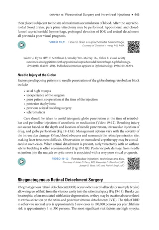 Chapter 19: Vitreoret­
i­
nal Surgery and Intravitreal Injections ● 445
then placed subjacent to the site of maximum accumulation of blood. ­
After the supracho-
roidal blood drains, pars plana vitrectomy may be performed. Appositional and closed-­
funnel suprachoroidal hemorrhage, prolonged elevation of IOP, and ret­
i­
nal detachment
all portend a poor visual prognosis.
VIDEO 19-11 How to drain a suprachoroidal hemorrhage.
Courtesy of Christina Y. Weng, MD, MBA.
Scott IU, Flynn HW Jr, Schiffman J, Smiddy WE, Murray TG, Ehlies F. Visual acuity
outcomes among patients with appositional suprachoroidal hemorrhage. Ophthalmology.
1997;104(12):2039–2046. Published correction appears in Ophthalmology. 1998;105(3):394.
Needle Injury of the Globe
­
Factors predisposing patients to needle penetration of the globe during retrobulbar block
include
• axial high myopia
• inexperience of the surgeon
• poor patient cooperation at the time of the injection
• posterior staphyloma
• previous scleral buckling surgery
• scleromalacia
Care should be taken to avoid iatrogenic globe penetration at the time of retrobul-
bar and peribulbar injection of anesthetic or medi­
cation (Video 19-12). Resulting injury
can occur based on the depth and location of needle penetration, intraocular injection of
drug, and globe perforation (Fig 19-13A). Management options vary with the severity of
the intraocular damage. Often, blood obscures and surrounds the ret­
i­
nal penetration site,
making ­
laser treatment difficult. Observation or transscleral cryotherapy may be consid-
ered in such cases. When ret­
i­
nal detachment is pre­
sent, early vitrectomy with or without
scleral buckling is often recommended (Fig 19-13B). Posterior pole damage from needle
extension into the macula or optic nerve is associated with a very poor visual prognosis.
VIDEO 19-12 Retrobulbar injection: technique and tips.
Courtesy of Julian D. Perry, MD, Alexander D. Blandford, MD,
Joseph D. Boss, MD, and Rishi P
. Singh, MD.
Rhegmatogenous Ret­
i­
nal Detachment Surgery
Rhegmatogenous ret­i­nal detachment (RRD) occurs when a ret­i­nal break (or multiple breaks)
allows ingress of fluid from the vitreous cavity into the subret­
i­
nal space (Fig 19-14). Breaks can
be atrophic, often associated with lattice degeneration, or they may be tractional tears related
to vitreous traction on the ret­ina and posterior vitreous detachment (PVD). The risk of RRD
in other­
wise normal eyes is approximately 5 new cases in 100,000 persons per year; lifetime
risk is approximately 1 in 300 persons. The most significant risk ­
factors are high myopia,
 