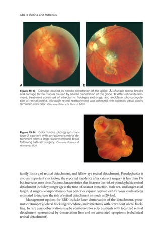 446 ● Retina and Vitreous
­
family history of ret­
i­
nal detachment, and fellow-­
eye ret­
i­
nal detachment. Pseudophakia is
also an impor­
tant risk ­
factor; the reported incidence ­
after cataract surgery is less than 1%
but increases over time. Patient characteristics that increase the risk of pseudophakic ret­
i­
nal
detachment include younger age at the time of cataract extraction, male sex, and longer axial
length. A surgical complication such as posterior capsule rupture with vitreous loss has been
estimated to increase the risk of ret­
i­
nal detachment as much as 20-­
fold.
Management options for RRD include ­
laser demarcation of the detachment, pneu-
matic retinopexy, scleral buckling procedure, and vitrectomy with or without scleral buck-
ling. In rare cases, observation may be considered for select patients with localized ret­
i­
nal
detachment surrounded by demarcation line and no associated symptoms (subclinical
ret­i­nal detachment).
A B
Figure 19-13 Damage caused by needle penetration of the globe. A, Multiple ret­
i­
nal breaks
and damage to the macula caused by needle penetration of the globe. B, ­After ret­i­nal detach-
ment, treatment consisted of vitrectomy, fluid–­
gas exchange, and endolaser photocoagula-
tion of ret­
i­
nal breaks. Although ret­
i­
nal reattachment was achieved, the patient’s visual acuity
remained very poor. (Courtesy of Harry W. Flynn Jr, MD.)
Figure 19-14 Color fundus photo­
graph mon-
tage of a patient with symptomatic ret­
i­
nal de-
tachment from a large superotemporal break
following cataract surgery. (Courtesy of Nancy M.
Holekamp, MD.)
 